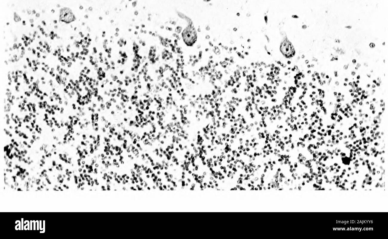 Den Ursprung und die Natur der Emotionen; verschiedene Papiere. 2 2 =^ £ 0,3 X;. Gehirn-ZELLEN UND GEHIRN TUNCTIONS 119 Nin. In der postmortal Prüfung eines erweiterten caseit wurde festgestellt, dass eine große Anzahl von Brain-Zellen wurden zerfällt nicht in der Macht der Rekuperation gerieben, auch thepatient hatte. Dies ist zweifellos der Grund, warum eine severecase der exophthalmic Kropf einen dauerhaften Verlust ofbrain Strom erhält. Schlaflosigkeit. - den Gehirnen von Kaninchen hatte wdiich keptawake Für hundert Stunden zeigte gerade die samechanges wie diejenigen, die in körperliche Ermüdung gezeigt, Gift Strychnin-ing und Erschöpfung her Stockfoto