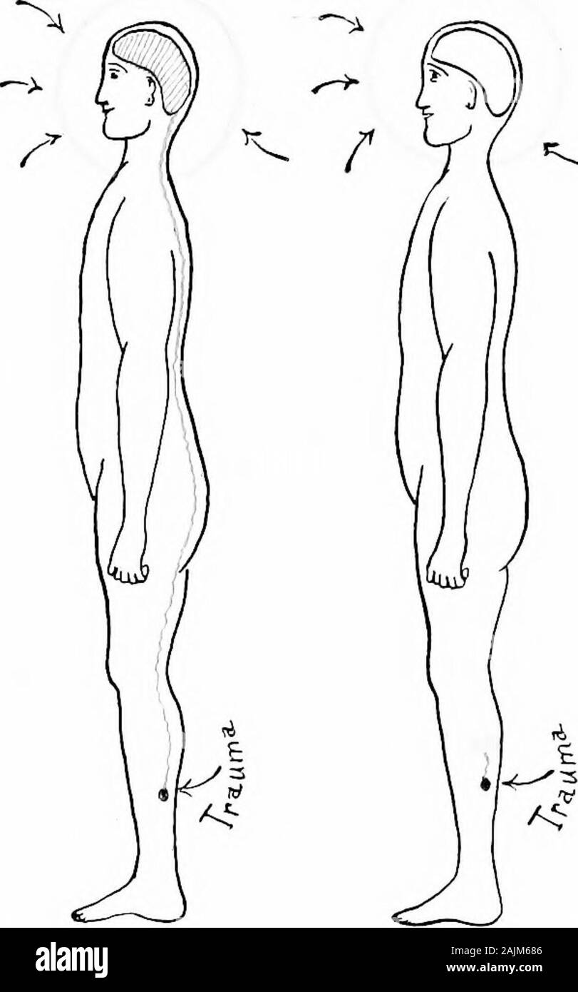 Den Ursprung und die Natur der Emotionen; verschiedene Papiere. ^. FiQ. 14.- Schematische Darstellung zur Veranschaulichung schützende Wirkung von Anoci-association.I. Bewussten Patienten, bei denen die auditive, visuelle, olfaktorische und traumaticnoci - Impulse zum Gehirn. Ii. Patienten unter Inhalation Anästhesie in denen onlj traumatische Noci-im-Pulse erreicht das Gehirn. Iii. Unter der vollständigen anoci-Verein Patienten; auditive, visuelle und ol-Fabrik Impulse werden vom Gehirn durch die Einatmung Anästhesie ausgeschlossen; traumatische Impulse aus dem Sitz von Verletzungen werden von novocain blockiert. Psychologie), Morphin, Inhalation Anästhesie, Stockfoto