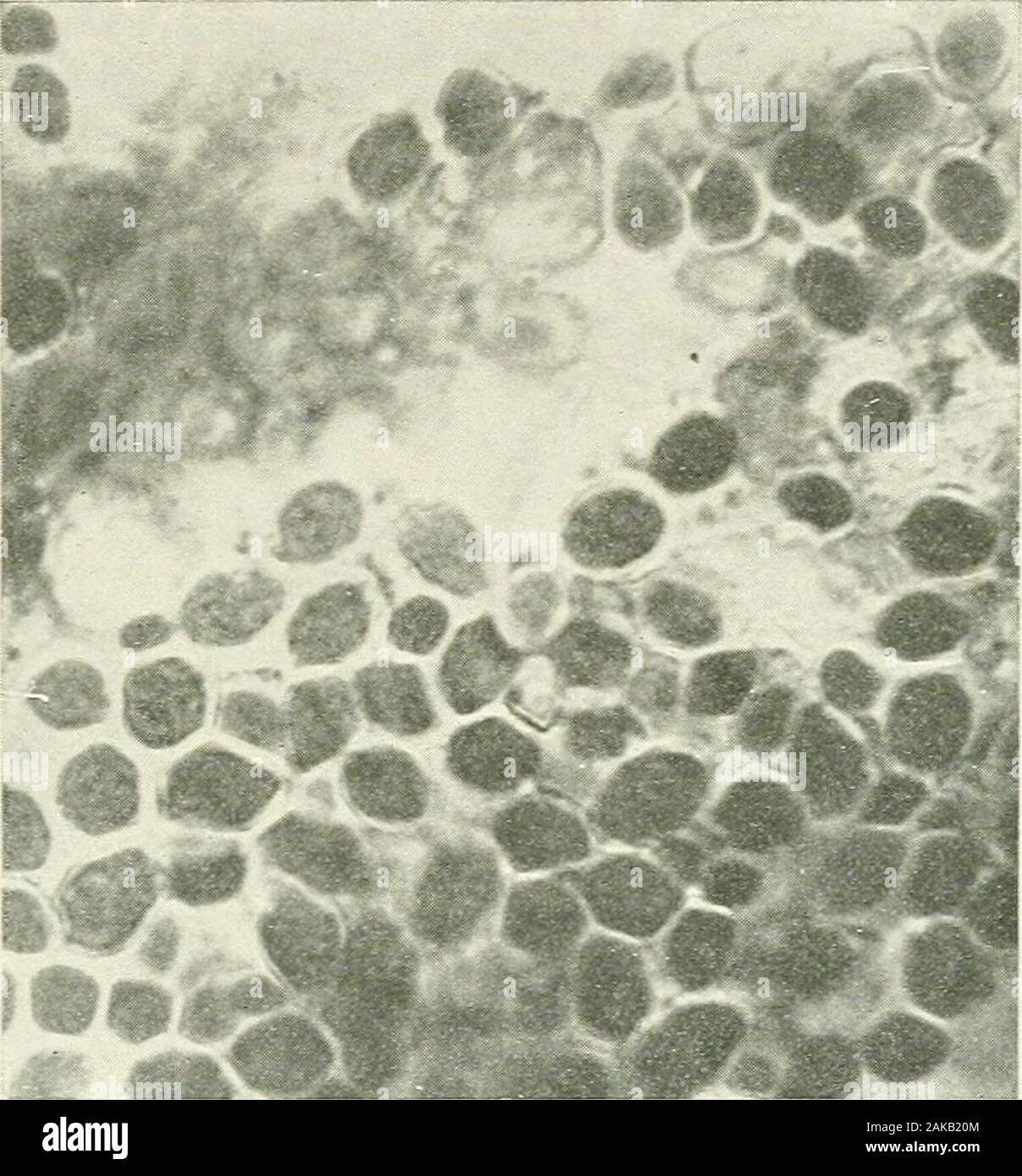 Krebs des Magens; eine klinische Studie von 921 operativ und pathologisch gezeigt. Abb. 53.Oppler-Boas Bazillen. Übersicht Halbkreis, Shinny stick andring Formen. Photomicrogram der alten Aufbewahrung Inhalt.- (Autor) ist Wa, Vj oder Korkenzieher-wie. Wenn dies so sein, unterschiedliche portionsof der Bazillus kommen in den Fokus zu unterschiedlichen Zeiten. Cer-tainly einige Der hghtly gefärbten Bereiche erscheinen darkerupon konzentriert. Die bacilU nehmen Sie die Jod gleichmäßig Fleck, und sind ein hght Gelb - Gelb mit Lugols Lösung gefärbt. Das hilft Ihnen möglicherweise zu fromleptothrix Formen unterscheiden und der gewöhnlichen Lac Stockfoto