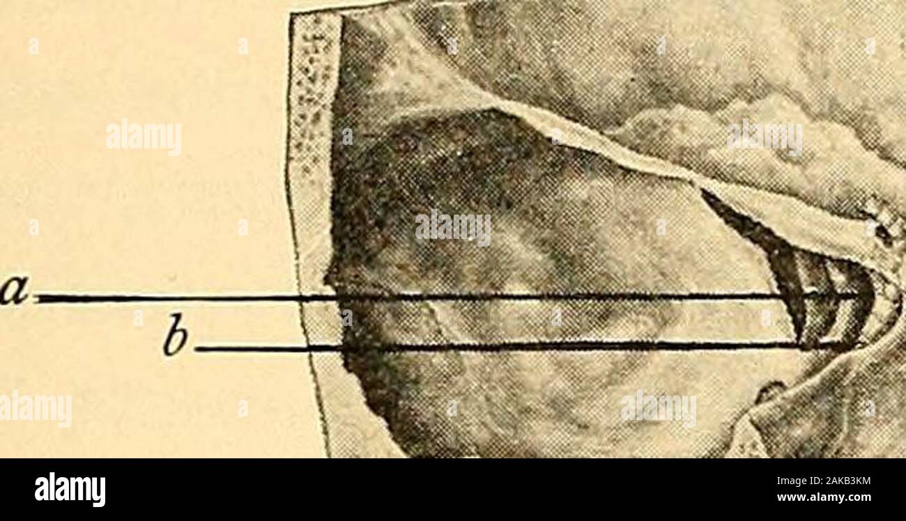 Erkrankungen der Nase und des Rachens. blique und superiortubercle sowie von der unteren cornua und von den Seiten des cricoid hinter dem crico - Schilddrüse Muskel. Die oberen Fasern über-Runde der Mitte constrictor, während die unteren kontinuierlich sind mitden Muskelfasern der Speiseröhre. In der Nähe der oberen Grenze der Bol-rior Laryngeal Nerv und Arterie durchbohren die thyro - hyoid Membran. Die wiederkehrenden Laryngeal Nerv tritt unter der unteren Grenze hinterdem crico - Schilddrüse Artikulation. Die Stylo-pharyngeus ergibt sich aus der Basis Der styloid processinternally und geht nach unten und nach innen zwisch Stockfoto