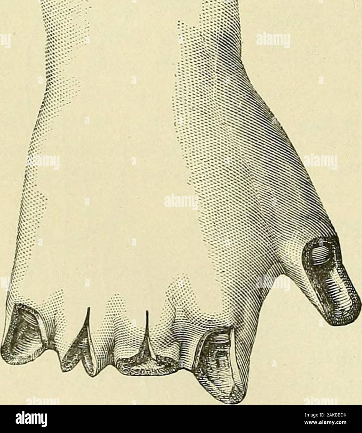 Ein Handbuch der modernen Chirurgie: eine Ausstellung der anerkannten Lehren und genehmigten operative Verfahren der Gegenwart, für die der Einsatz von Schülern und Studenten und Praktiker. nd erhalten. Amputation des Unterarms. Keine besonderen Punkte erwähnen. Die schräge Rundschreiben ist ein goodmethod, aber so ist das Doppelte klappe Methode. Die quer liegenden kreisförmigen in - cision oft im unteren Drittel wird dort eingesetzt, wo die Muskeln haben weitgehend becomeso tendinous. Die beiden Knochen sollten gleichzeitig gesägt werden. Exartikulation im Handgelenk. Dieser Vorgang sollte nur dann durchgeführt werden, wenn es möglich ist, eine portionof zur Hand oder eine pa-Speichern Stockfoto