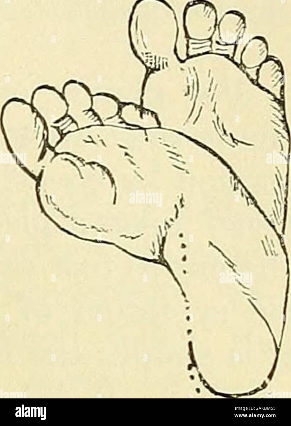 Ein Handbuch der modernen Chirurgie: eine Ausstellung der anerkannten Lehren und genehmigten operative Verfahren der Gegenwart, für die der Einsatz von Schülern und Studenten und Praktiker. Zehen, solangedie Höhe der Ferse wird durch die wadenmuskulatur, die durchdie Sehne des Achilles produziert. Die plantar fascia und andere Muskeln thanthose erwähnt werden, können von Zeit zu Zeit abgeschlossen werden und die Deformität zu erhöhen. Behandlung. - Die Umkehrung der Fuß sollte durch tenot behandelt werden- schaft des Nervus tibialis anterior Sehne und vielleicht von der posterioren tibialtendon. Vielleicht die plantar fascia und einige der anderen tendonsmay erfordern Sekte Stockfoto