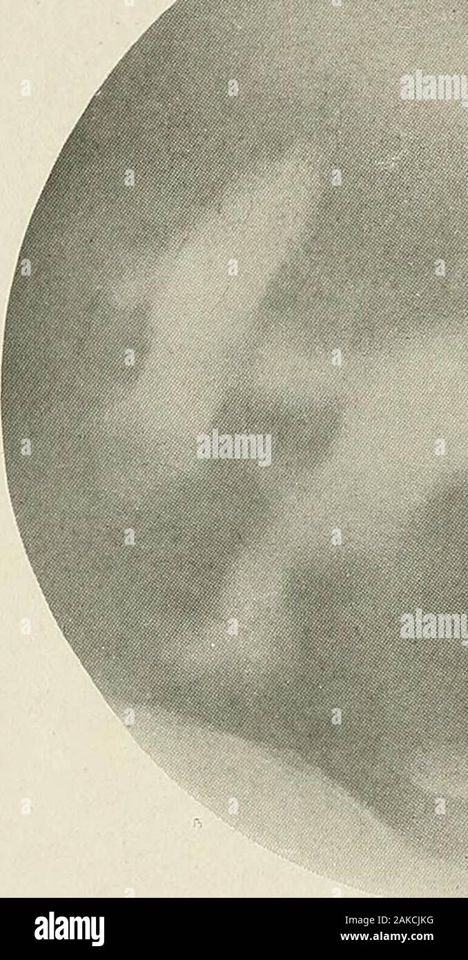 (Pyelography pyeloureterography) eine Studie über die normale und