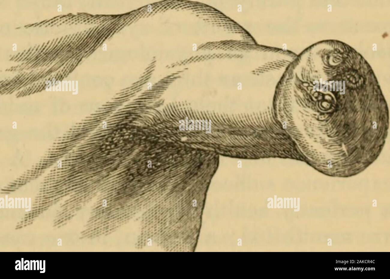 Ein System von Hebammen: Einschließlich der Erkrankungen während der Schwangerschaft und der Puerperalen Zustand. einer raisedcutaneous Falten, oder Fleischigen Masse, oder tuberkel, und auf seine surfaceone, zwei oder mehr kleinere Projektionen oder Knötchen, eingerichtet mit minutenails. In Abbildung dieses, die angehängt Gravur gegeben ist, repräsentiert der Zinsgarantie der Stumpf des linken 1 Unterarm eines Fötus des siebten Monats, in der Geburtshilfe Mu seum bewahrt - der Universität von Edin-FK&gt;. m. Burgh. Es gibt fünf withminute smallrudimentary Finger Nägel, in den üblichen Posi-tion auf das Ende des Stumpfes. Abweichungen von der normalen Stockfoto