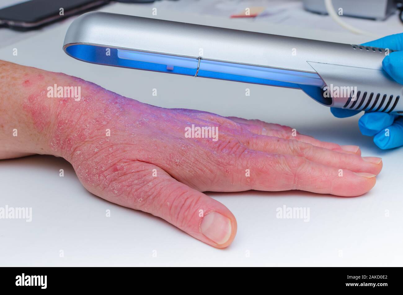 Phototherapie Dermatosen. Behandlung von Hauterkrankungen, Psoriasis, Neurodermitis, Vitiligo ekzemy, - Bestrahlung mit einem schmalen Band Ultraviolett. Stockfoto