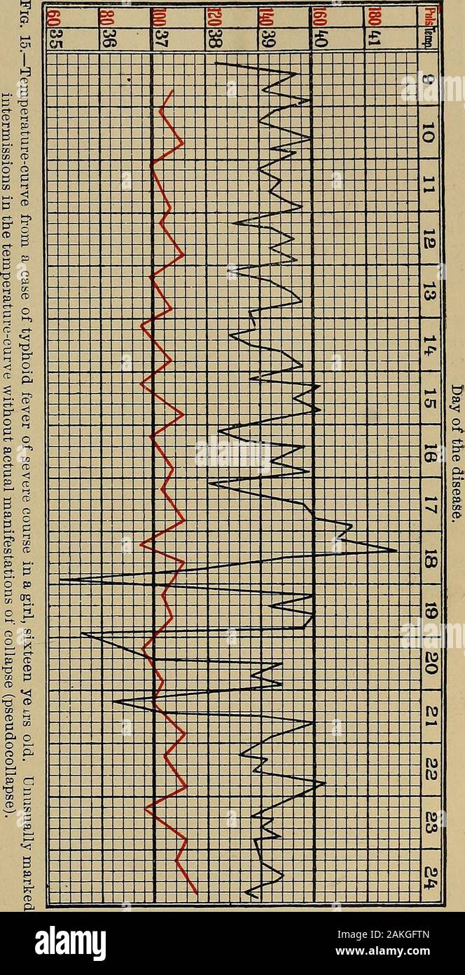 Typhus und Fleckfieber. Fieber, in anderer Hinsicht alsonot besucht withalarming Symptome, und die Desig sind- gerechnet, ich habe pseudocollapse inseveral Fälle in whichthere beobachtet wurden, waren zwei orthree Erhöhungen täglich (Abb. 15). Die Erklärung bemerkenswerte Ausma§, Undvom prognosticstandpoint occurrencewill generallyindifferent, lange bleiben Ob-scure. In der Gegenwart ofsuch pseudocollapse jedoch die Progno-sis sollte guardedif werden die Bühne des steepcurves soonthereafter nicht beginnen oder notactually theirappearance theintermissions tun. Ganz im Gegenteil, Körper-Temperatur riseaga Stockfoto