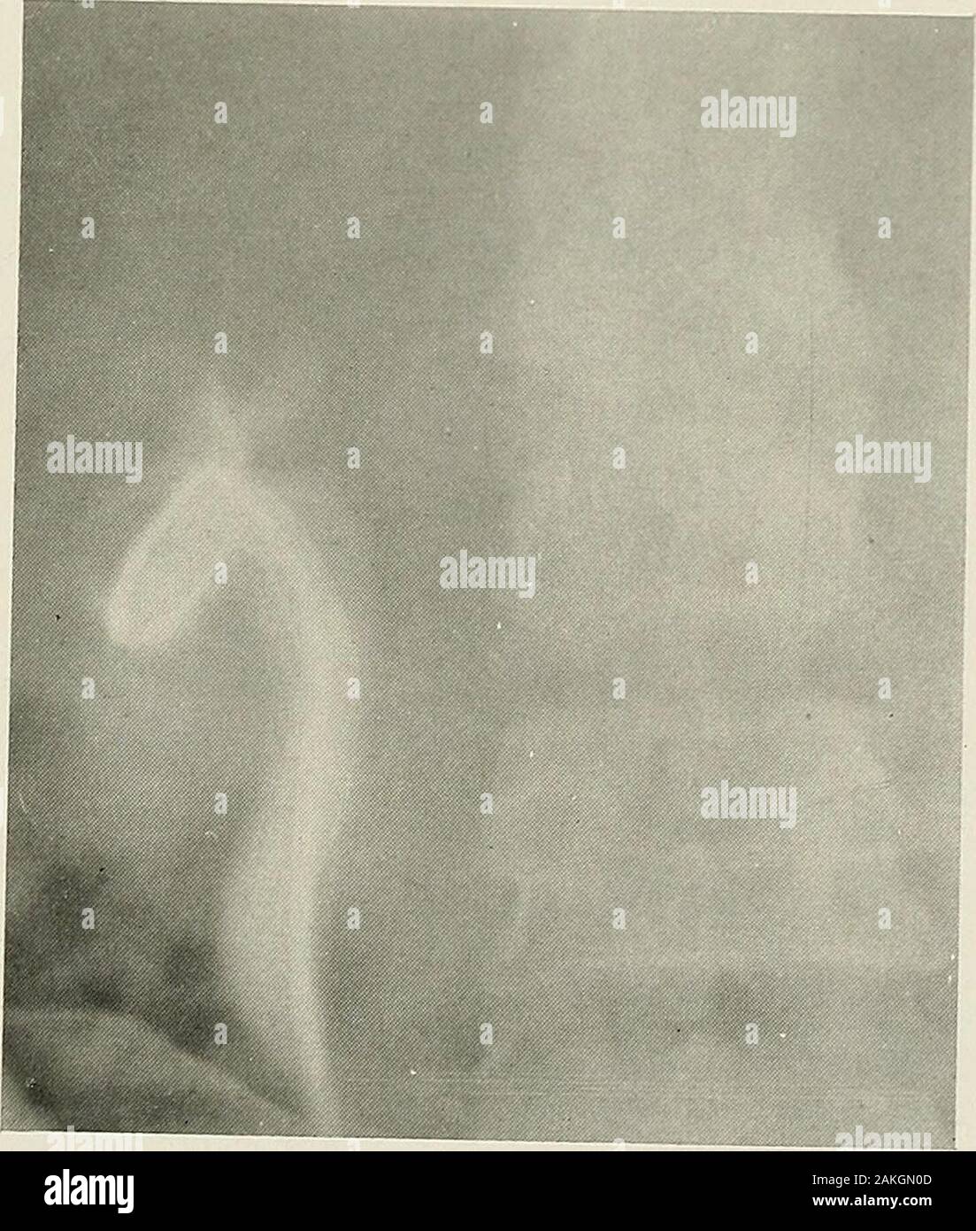 (Pyelography pyelo-ureterography) eine Studie über die normale und pathologische Anatomie von Nierenbecken und Ureter. Abb. L 51.- nieren Tuberkulose (striktur der Harnröhre). Abb. 152.-renale Tuberkulose (striktur der Harnröhre). 182 PYELOGRAPHY andeutend eine einfache entzündliche Verengung des Harnleiters. Jedoch die deutliche entzündliche Veränderungen des outlineof des Beckens und der Bereich der kortikalen Nekrose connectedwith den oberen Teil des Beckens weist darauf hin, dass Bestellvorgang Tuberkuloseläsionen festgestellt wird. In Abb. 151 Der ureter ist markedlydilated über einem Punkt der Obstruktion 6 oder 7 cm. Oben thebladder. Die Stockfoto