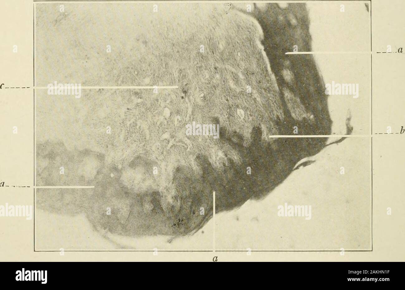 Allgemeine und zahnmedizinischen Pathologie mit besonderer Berücksichtigung der Ätiologie und der pathologischen Anatomie; eine Abhandlung für Studierende und Praktiker. y Layer; b. b, Stratum germinativum oder stratum Malpighii; c, c, capil-lary Netzwerk in Papille aus zugrunde liegenden Bindegewebe - gewebe Stroma (mat); d, d, Connec- tive-Gewebe stroma; c, Gefäß im stroma;/, epithel Futter innere Oberfläche von gingi - Val cul-de-sac, g. Füllt fast ausschließlich die interproximal Raum zu einem kurzen Dis- nisse aus der Kontaktstelle, die Federn von der AP-proximalen Teile des Körpers der gingivae. Mit dem Zahnfleisch? Sind angefügt Stockfoto