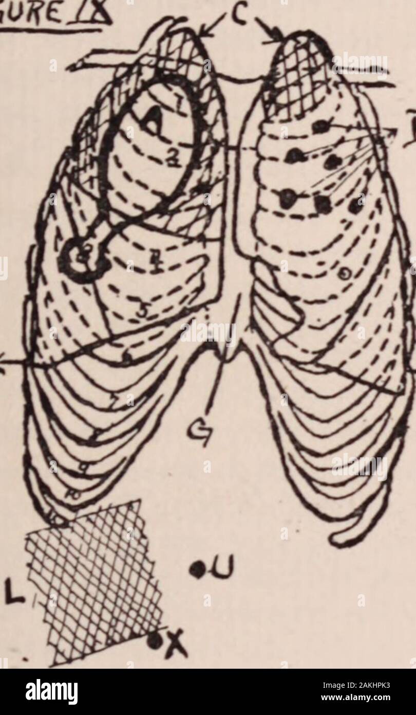 Albany Medical Annalen. om die zweite Rippe an den rippenbögen Marge Therewas eine hyperresonant Hinweis und die gesamte Leber Dumpfheit war unterhalb der rippenbögen Marge forceddown. Posteriore Bestrahlungen auf der rechten Seite es wasa Flachbild Hinweis, der sich von der Basis nach oben auf die Höhe der sthvertebral Wirbelsäule. Die Temperatur Diagramm (siehe Abb. VI) zeigt dieselbe relationshipbetween Temperatur, Puls und Atmung wie in Fall gab ich (ChartIII). MALCOLM DOUGLAS 93 Die Diagnose wurde offensichtlich mit den Erkenntnissen der hyperresonance, Fluid, Vertreibung von Leber, schwachen Atemgeräusche und zusammenbrechen. Er wurde schnell schwächer und di Stockfoto