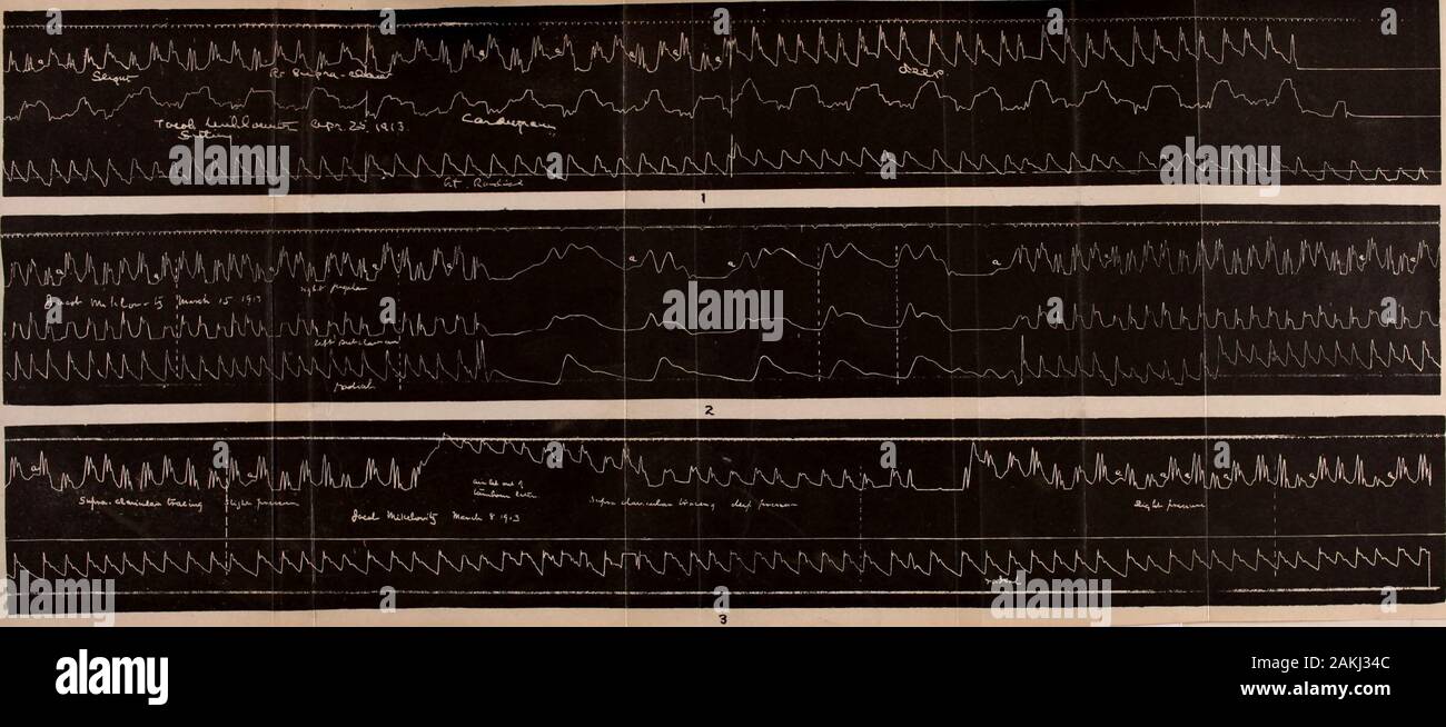 Albany Medical Annalen. und Diastole, ungefähr die gleiche Länge. Diese Kurve als ziemlich typisch getroffen werden können, wenn eine beliebige Kurve becalled Typische unter der unendlichen Vielfalt des apikalen cardiograiiis können. Es zeigt auch den Einfluss der Atmung, aber in einem anderen wayfrom Kurve Nr. C-i, in dem es keine Wellenlinie, aber die largerpulse Kurven treten während der Ablauf, die Kleineren duringinspiration. Dass diese rhythmische Variationen in der cardiogramare Aufgrund der Atembewegungen ergibt sich aus tracingNo. C-5, in der es sowohl die W^avy Linie und der variationin Größe der Cu Stockfoto Albany Medical Annalen. und Diastole, ungefähr die gleiche Länge. Diese Kurve als ziemlich typisch getroffen werden können, wenn eine beliebige Kurve becalled Typische unter der unendlichen Vielfalt des apikalen cardiograiiis können. Es zeigt auch den Einfluss der Atmung, aber in einem anderen wayfrom Kurve Nr. C-i, in dem es keine Wellenlinie, aber die largerpulse Kurven treten während der Ablauf, die Kleineren duringinspiration. Dass diese rhythmische Variationen in der cardiogramare Aufgrund der Atembewegungen ergibt sich aus tracingNo. C-5, in der es sowohl die W^avy Linie und der variationin Größe der Cu Stockfoto
