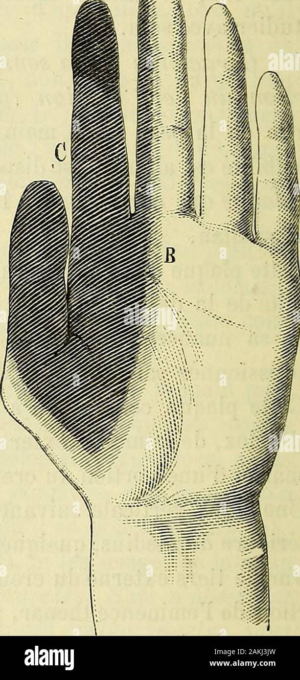 "Traité des Abschnitte nerveuses: Physiologie, pathologique: Indikationen - procédés opératoires. Fia. 2. - Plakette danesthésie après la Partie du Nerf médian. Cette Plakette nest pas complètement Privée de sensibilité. Elle einen Sohn maainium dinsensibilité à lextrémité delindex et, surtout, à sa Gesicht palmaire. Je lai représentéesur la Abbildung par une teinte très - ombrée (A A). Au pourtour de ces Punkte nuancés fortement en Noir se ABSCHNITT DU NERF MEDIAN 43 trouvent des Régions * insensibles (C); et Enfin, surles Bords, La teinte plus Claire (B E H) indique le mini-Mama danesthésie que Lon beobachten. Stockfoto