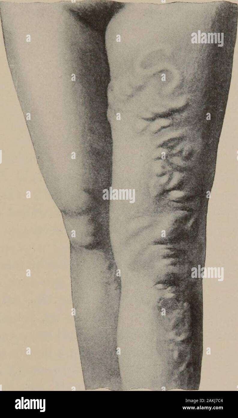 Eine Bedienungsanleitung Pflegepersonal der Geburtshilfe. - Ursache für schwere Belastung Bemühungen am Stuhl oder auf Rechnung einer Ex-Spannung der bestehenden intestinalen Entzündung. Rizinusöl, so häufig zu Beginn einer einfachen Diar - rhoea nicht während der Schwangerschaft zugeteilt werden außer durch direkte orderof der Arzt, denn es ist zu berücksichtigen, dass die abortifacientproperties der Droge sind so gut markiert, dass Sie earnedfor es die wenig beneidenswerte Name der Armen womans Mutterkorn. Dyspnoza (Atemnot) Ergebnisse gelegentlich frompressure auf der Membran der schwangeren Gebärmutter, und vielleicht ausreichen, die in den letzten Stockfoto