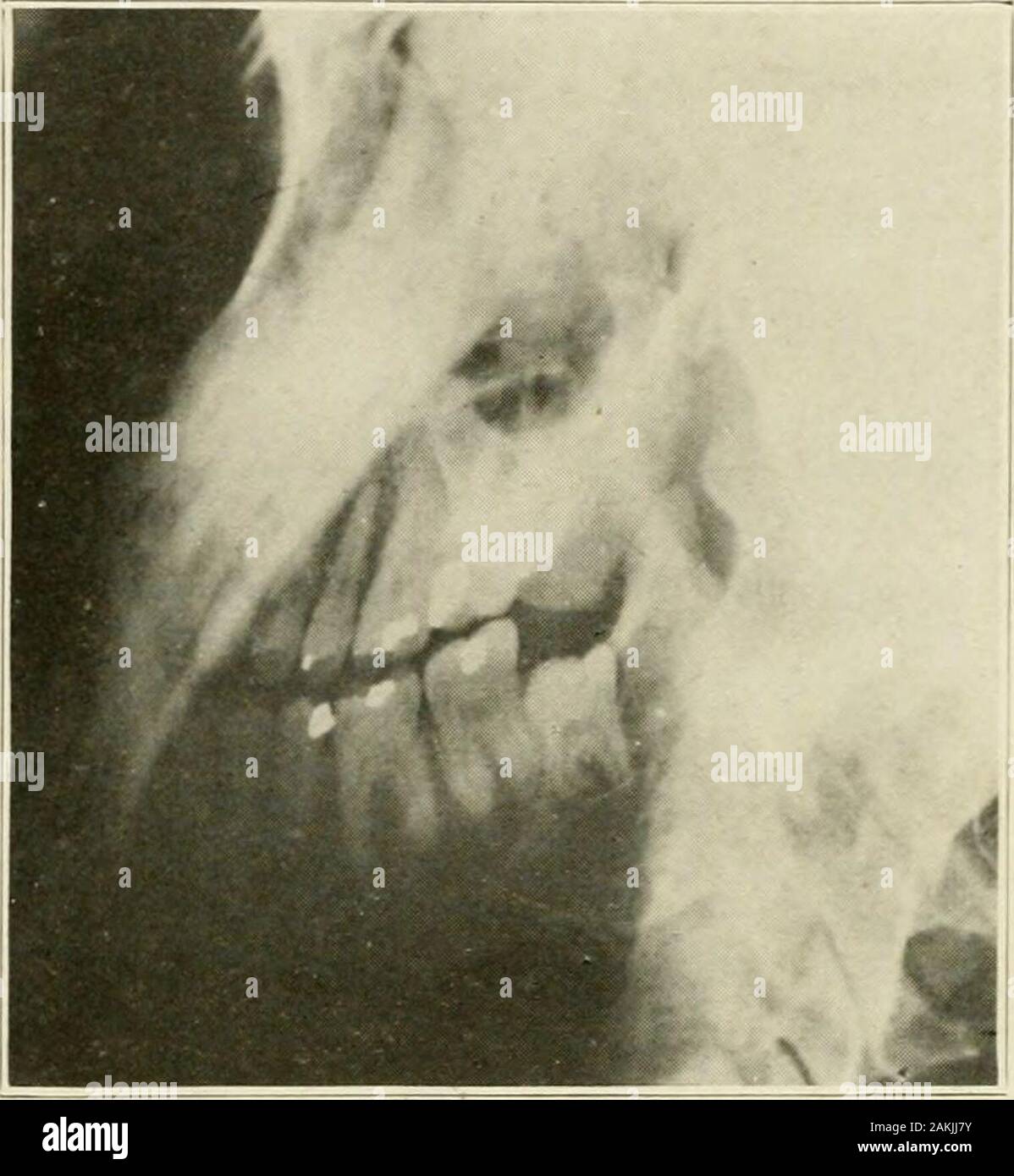 Allgemeine und zahnmedizinischen Pathologie mit besonderer Berücksichtigung der Ätiologie und der pathologischen Anatomie; eine Abhandlung für Studenten und Praktiker. Abb. 225. wollte, daß wissenschaftliche therapeutist Soullier von Lyon, Thesignificance gestörter funktionelle Aktivität von continueddegrees von Schmerzen zu schätzen, dass er mit diesem Symptom als thenervous System was Blutungen ist an die vaskuläre bezeichnet. 2 % ZAHNMEDIZINISCHEN PATHOLOGIE Fallbeispiele eine junge Frau, 20 Jahre alt, hatte Leiden intensiven painfor einen Zeitraum von mehreren Monaten. Sie hatte einen Verlust im Gewicht von sechs aufrechterhalten. Abb.! 226. Stockfoto