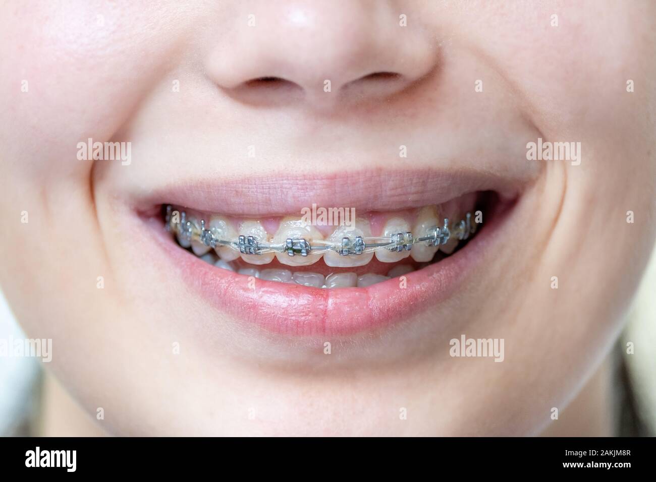 Klammern für die Ausrichtung der Zähne Zähne auf die Frau. Medizinische zahnmedizinische Konzept. Nahaufnahme Stockfoto