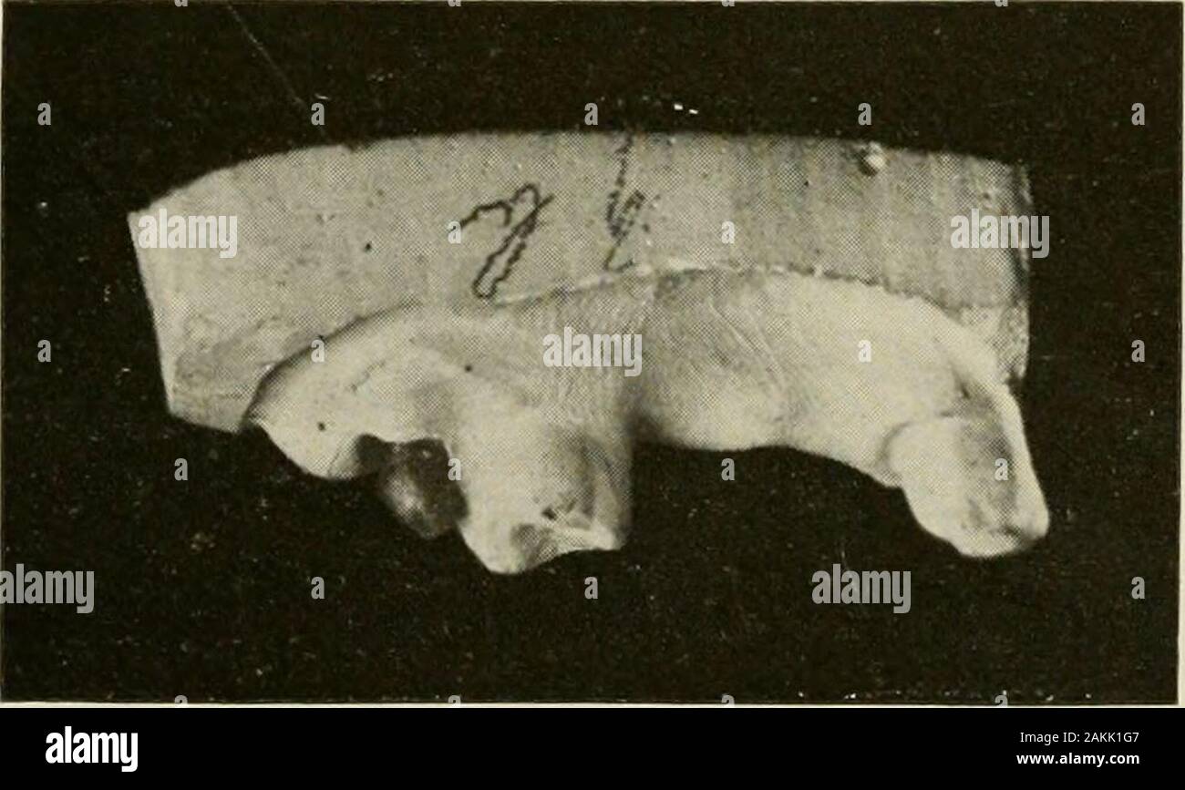 Allgemeine und zahnmedizinischen Pathologie mit besonderer Berücksichtigung der Ätiologie und der pathologischen Anatomie; eine Abhandlung für Studenten und Praktiker. Abb. 197.- in den Schatten gestellt unteren dritten Molaren.. Abb. 198.- in den Schatten gestellt oberen dritten Molaren. Je weniger häufig der Sitz der anormale Entwicklung als ersten Molaren. Die Wurzeln können konvergieren in der apices. 5A lowersecond Molare kann vier gut entwickelte Wurzeln (Abb. 194). BBarrett: loc. cit. MAKROSKOPISCHE PKFOKMITIKN DER ZÄHNE ist: Dritte Molaren. - die dritten Molaren ist häufig der scat von ab-normale Entwicklung. Prom Ihe und lowerthird almosl Perfekt oberen Molaren re Eng Stockfoto