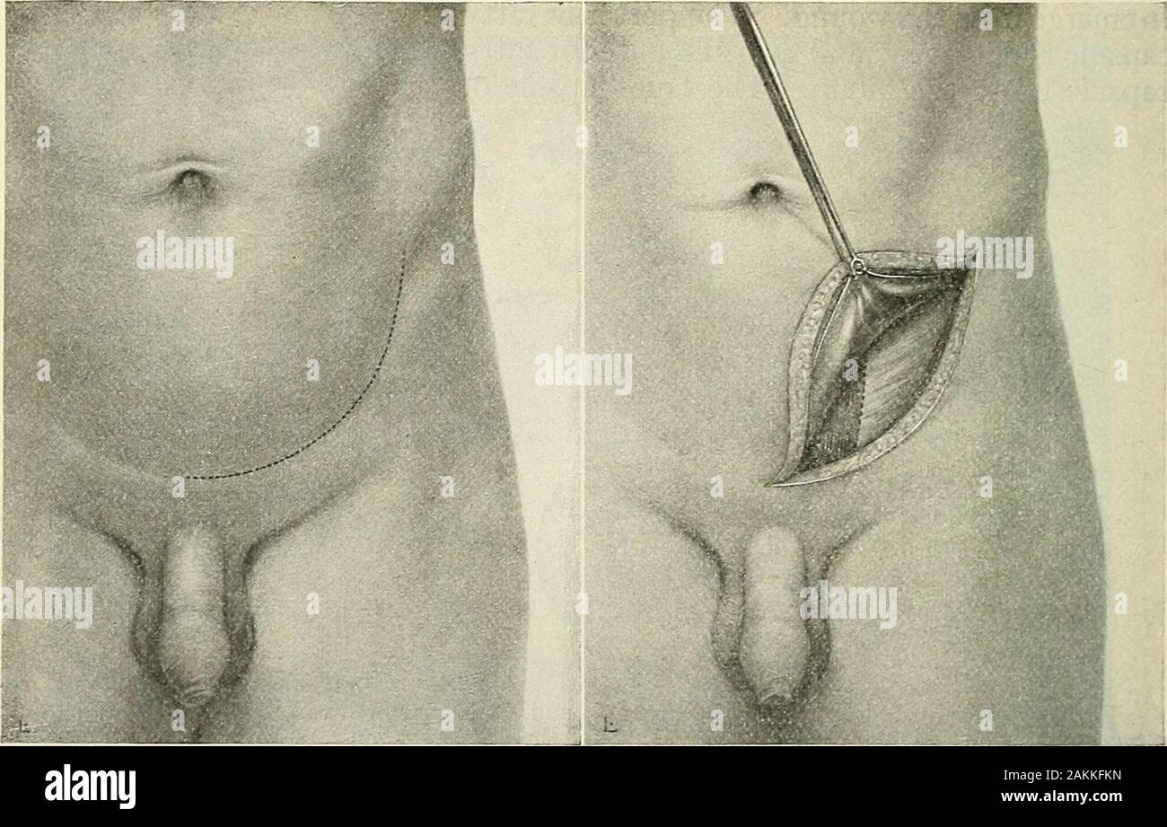 Die moderne Chirurgie, allgemeine und operative. ed die super-ficial Teile und die Lendenwirbelsäule aponeurosis zu schließen; einige sind gebunden und einige sind leftimtied. Ein großes Stück Gaze auf dem Bauch über den vorderen sur platziert - Gesicht der Niere und der lendenwirbelsäule Wunde ist mit Gaze gekleidet. Die dress-ing und mullauflage werden mit einem Bindemittel statt. In etwa acht oder zehn daysthe Gaze sollte getränkt mit tropfenden Salz Lösung während einer halben Stunde unddie Verpackung entfernt werden. Zu dieser Zeit ist die catgut ist zerstört und die gaze Kannmit leicht herausgezogen. Gebunden das sutmres geschnitten sind und entfernt werden, die Nähte leftunfastened Ar Stockfoto