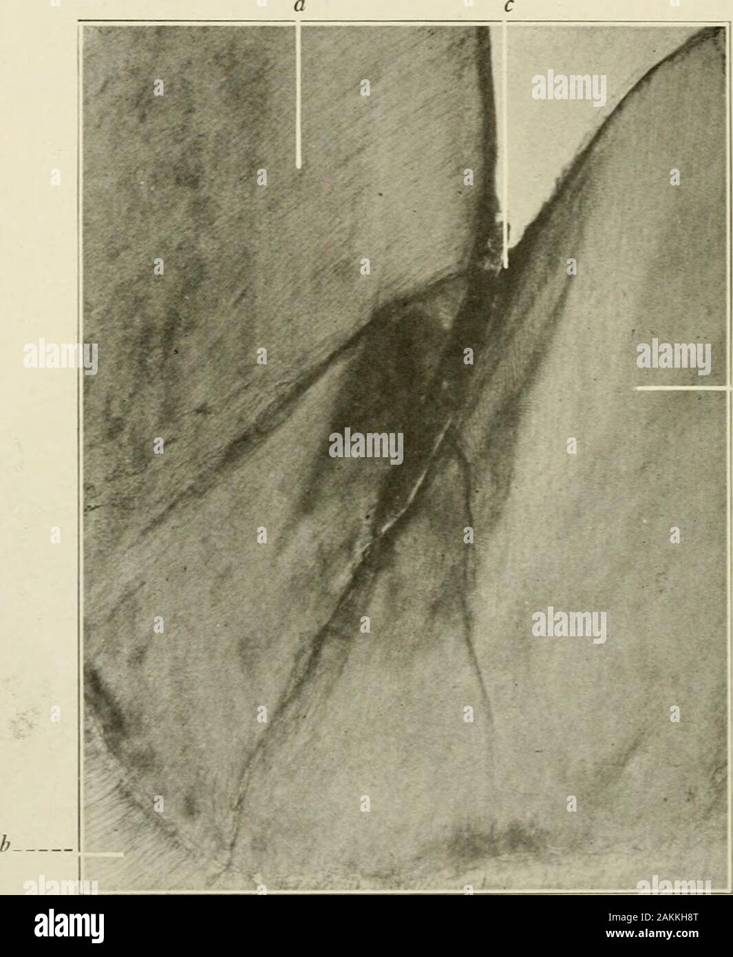 Allgemeine und zahnmedizinischen Pathologie mit besonderer Berücksichtigung der Ätiologie und der pathologischen Anatomie; eine Abhandlung für Studierende und Praktiker. alcification des fissuresand fehlerhafte Entwicklung des ena. mel Stangen im Bereich der Spitze, ein, unvollständige fusionof die cusps einer Bicuspid in einem Defecting verkalkte Riss; b. Störungen in thearrangement des Zahnschmelzes Stangen. Die histologische Zeichen des Zahnschmelzes Stangen im thearea bei b, wollen. mentale Perioden nach der Geburt, als hypoplasie klassifiziert. Unter thisheading der Studie der entwicklungspolitischen Mängel der Zahnschmelz, den-Zinn und wurzelzement wird b Stockfoto