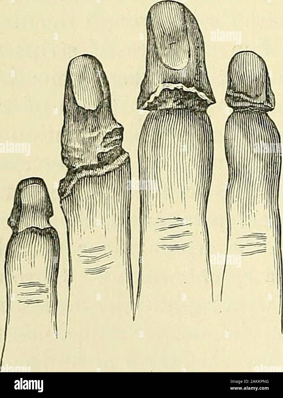 Ein Handbuch der modernen Chirurgie: eine Ausstellung der anerkannten Lehren und genehmigten operative Verfahren der Gegenwart, für die der Einsatz von Schülern und Studenten und Praktiker. Der frühere Zustand kann causedby Hindernis in die Arterien werden, wie aus ligation, Bruch, Lungenembolie, Verstopfung durch eine große Anzahl von Bakterien, Abb. 7. 0 r erkrankten Arterienwand; Verstopfung in den Adern, als von den festen Bandagieren; ob Bau in den Kapillaren, als aus Druck von Tumoren oder entzündlichen Einlagen oder ergotismus, Herz Schwäche, die ismerely Zubehör verursachen, abnehmende theactivity der Zirkulation; inflamm Stockfoto