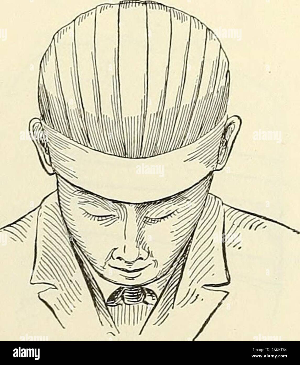 Die moderne Chirurgie, allgemeine und operative. rehead, die ein Teil der precedingturn; dieses Verfahren fortsetzen, bis die Kopfhaut gut bedeckt ist; mit twocircular dreht sich um die Stirn und Kopf (Abb. beenden. 840). Es ist oft advisableto eine Umdrehung um den Kopf und Kinn. Stift die gekreuzten Stücke. Wiederkehrende Verband von einem Baumstumpf. - eine Walze 2 Zoll breit und 6 m lang. Zwei leichten kreisenden dreht sich um die Wurzel des Baumes; wiederkehrende schaltet über den stumpf machen wie in den Kopf getan ist; eine Runde drehen, um die Wurzel des Baumes, schräge dreht sich um den luftentweichen, der Stumpf, c Stockfoto