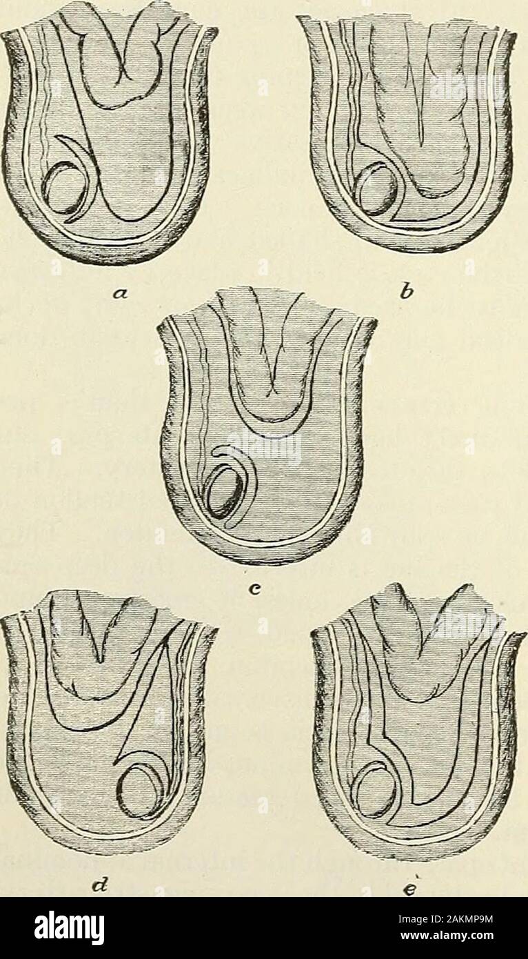 Die moderne Chirurgie, allgemeine und operative. uinal Regionen. Einen ven- Hernie kann Median {herniaof der Linea alba) oder seitlich. Thetreatment ist radikal. Epigastrischen Hernie ist eine Form der ventralen Hernie. In diesem Zustand gibt es isa Vorwölbung des Bauchfells im Raum durch die ensiform Knorpel begrenzt, die Rippen und den Bauchnabel. Die Sac von bauchfell kann leer sein, maycontain omentimi oder Omentum und Darm. Der Magen sehr selten passesinto der Sac. Der Überstand ist normalerweise, aber nicht unveränderlich, durch die lineaalba. Die Bedingung kann durch eine angeborene Lücke in der transversalisfas werden Stockfoto