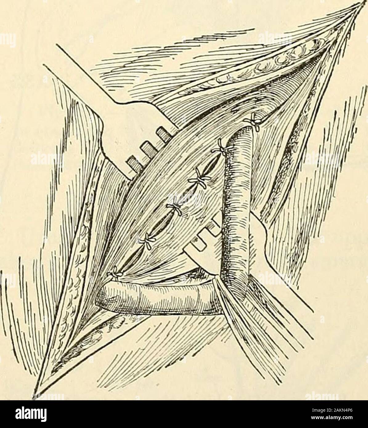 Die moderne Chirurgie, allgemeine und operativen. Abb. - 735 - A-c, Bassinis Betrieb für die cureof Leistenbruch (Esmarch und kowalzig). Abb. 736.- Bassinis Betrieb (tiefe Nähte), zusätzliche Naht über die Schnur, wie advisedby Coley. Amerikanische Operatoren verwenden, Kangaroo - Sehne oder chromicized catgut. Bassiniinserts zuerst die Nähte am nächsten zum PUBES. Die erste Naht- und sometimesalso der zweiten umfasst einen Teil des rectus Ummantelung und rectus Muscle. Eachstitch enthält die interne schräg und Transversalis Muskel im oberen edgeand die Haltbarkeit der Pouparts ligament unterhalb der unteren Marge, und von fo Stockfoto