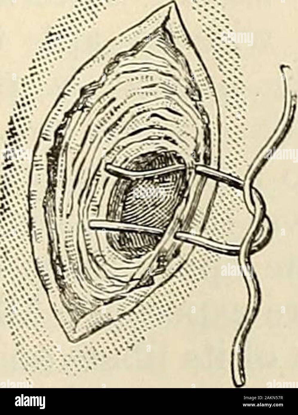 Die moderne Chirurgie, allgemeine und operativen. Abb. 733.- Macewens Betrieb für radikale Heilung der Leistenbruch: EIN, Abisolieren des Sac: B, Geldbörse - string Naht; c, Befestigung der Geldbeutel-string Naht, D, und E, tjdng, die Nähte für: diemasseschrauben Ring. Patient liegt recimibent, den Oberschenkel entführt und teilweise gebogen und Rest-ing auf ein Kissen unter die Knie. Der Darm ist reduziert, und ein Schnitt 3 Zoll lang wird in Richtung der leistenkanal, das Zentrum von theincision entsprechend der äußere Ring. Der sac ist von seiner Befestigung befreit - rungen unten und nach oben gehoben. Der Chirurg i Stockfoto