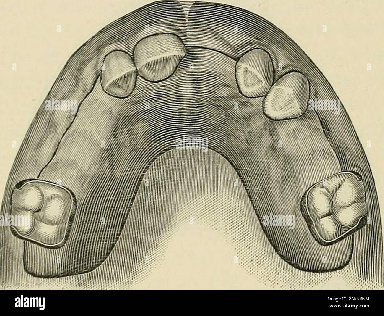 Eine praktische Abhandlung über mechanische Zahnheilkunde. Ein schmaler Rand der Platte oder halbe runde Draht entlang der Grenze neben den Zähnen und dem Verschluss, wenn prac-ticable, pass vor und begrüßen die vordere Fläche des toothto die es angewandt wird. Wenn eine anteriore bicuspid ausgetauscht werden muss, die Platte kann beattached zu den angrenzenden Bicuspid, oder wenn beide nicht vorhanden sind, dann auf I5C MECHANISCHE ZAHNHEILKUNDE. Die ersten Molaren, oder der Verschluss kann sowohl der Letzteren ifremaining und keine Trennung zwischen Sie umarmen vorhanden ist. Nehmen Sie einen Fall, wo es notwendig ist, den Verlust der twobicuspids auf der einen Seite zu liefern, ein Stockfoto