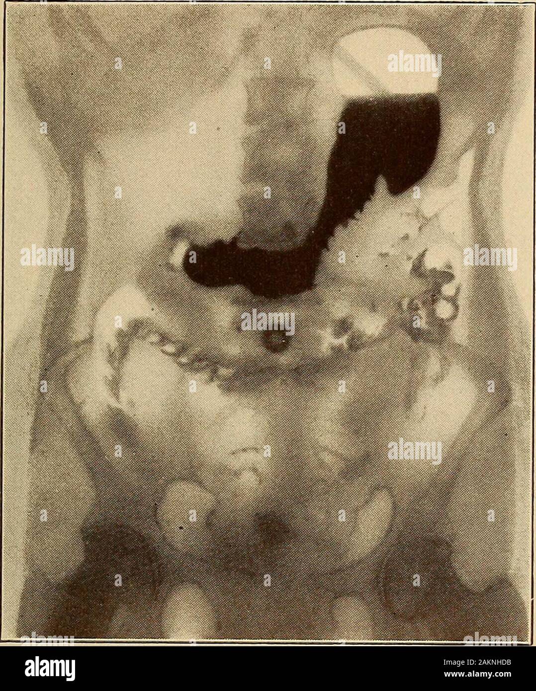 Chronische und atrophische gastritis Fotos und Bildmaterial in hoher