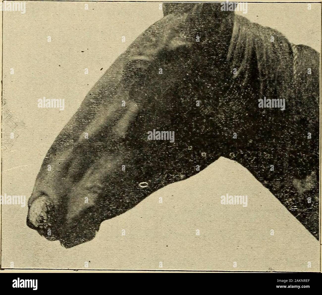 Tumore nasale Fotos und Bildmaterial in hoher Auflösung Alamy