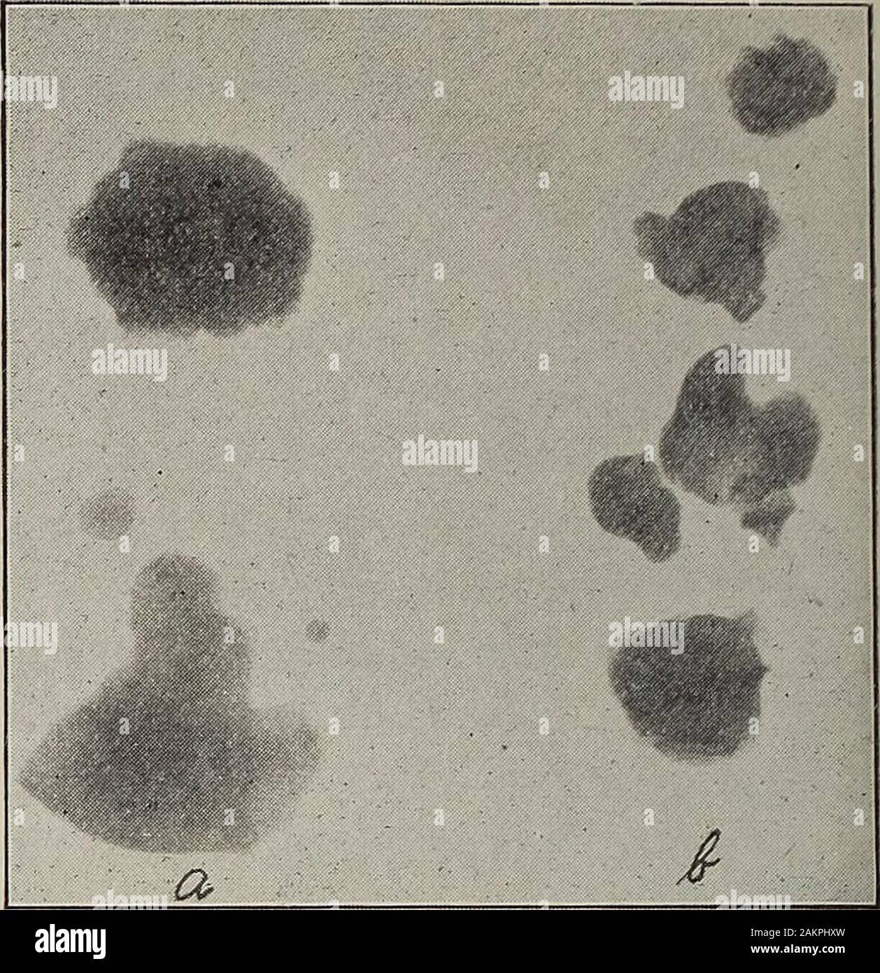 Die Archive der physiologischen Therapie. I. in der Exposition drei Minuten mäßig hartes Rohr. Abb. 2. Drei Minuten Exposition, weiche Tube. Abb. 3. Vier Minuten Exposition, weiche Tube. Die Zahlen 1, 2 und J shoiv Kalküle skiagraphed ohne Membrane. urate bestehen aus Kalium andsodium, das Atomgewicht des latterbeing 40, von Kalium 39, Phos-phorus 31, Magnesium und Natrium 24, 23. Die spezifische Dichte der is1.6 Calcium, Kalium 0,9, Phosphor 2,0, mag-nesium 1.7, und Natrium i.o. Die Praxis zeigt jedoch, dass wir oft findthat Kalküle sind nicht von einem bestimmten Typ, und falls dem so ist, werden die Schichten von verschiedenen Stockfoto