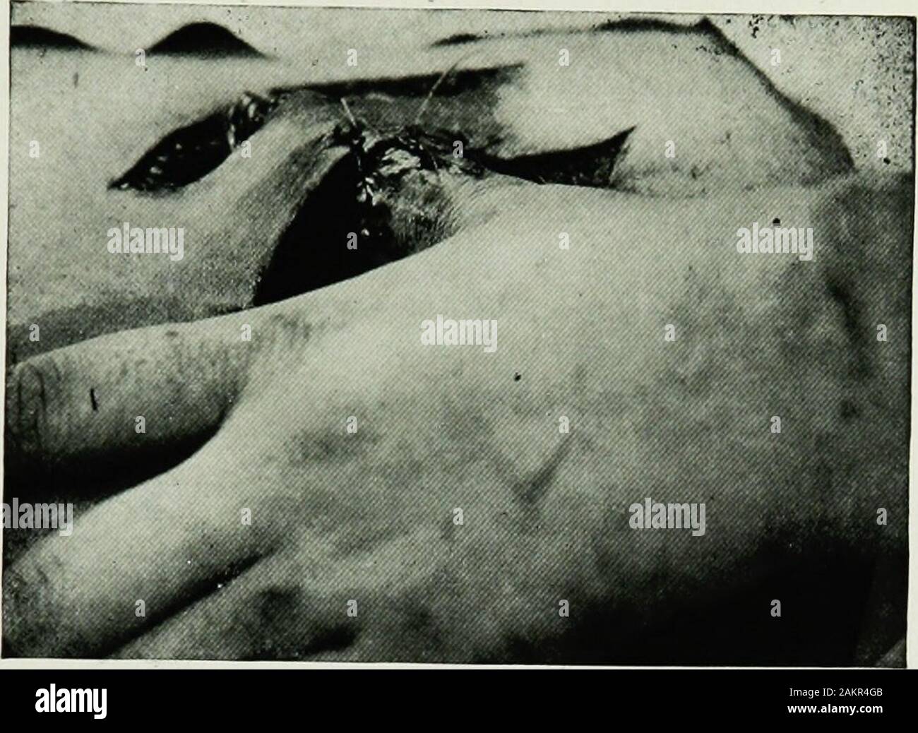 Krieg Chirurgie des faceA Abhandlung über plastische Wiederherstellung nach Verletzungen des Gesichts von John BRoberts.. auf Anregung der Motive auf Kunststoff- und Oralchirurgie mit dem Büro der Chirurg generalIllustrated mit 256 Figuren verbunden vorbereitet. Abb. 122.- Dieffenbachs Methode der Modellierung brachital Klappe vor dem attachingit Region in Rhinoplastik, Nasen. F. Strategische: Temporäre Verdrängung, wie Aufteilung der Unterkiefer zu reachthroat und Gaumen, Schneiden zygoma an der Basis ofskull zu erhalten; Als Verdrängung Oberkiefer oder Nase Zugang tonaso-Tumoren, ich zu gewinnen. Art und Weise der kutanen Klappen mit Pedic Stockfoto