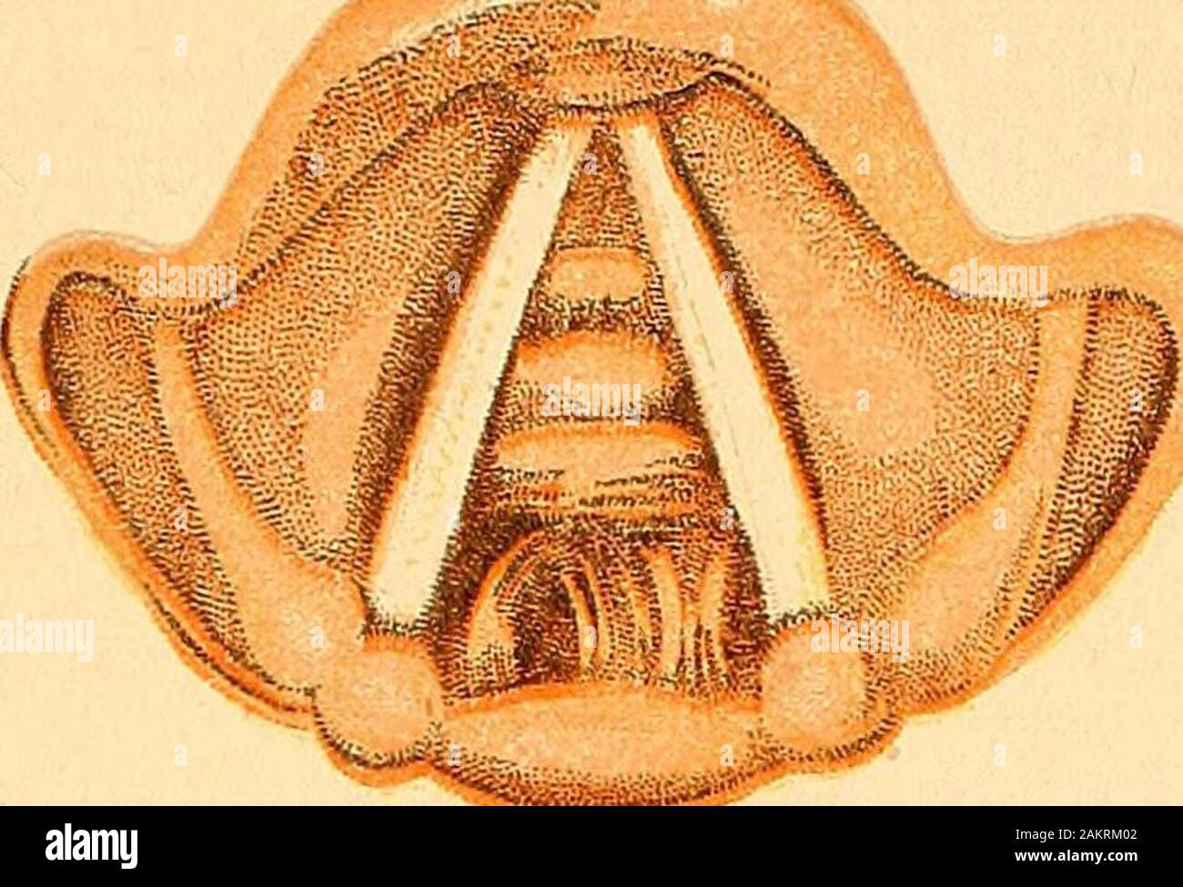 Erkrankungen Der Nase Und Des Rachens Ein Lehrbuch Fur Studenten Und Praktiker Der Kehlkopf Bild 351 Phthisical Und Anderen Krankheiten Innerhalb Der Laryngealcavity Gelegen In Der Ary Epiglottic Falten Sind Oft