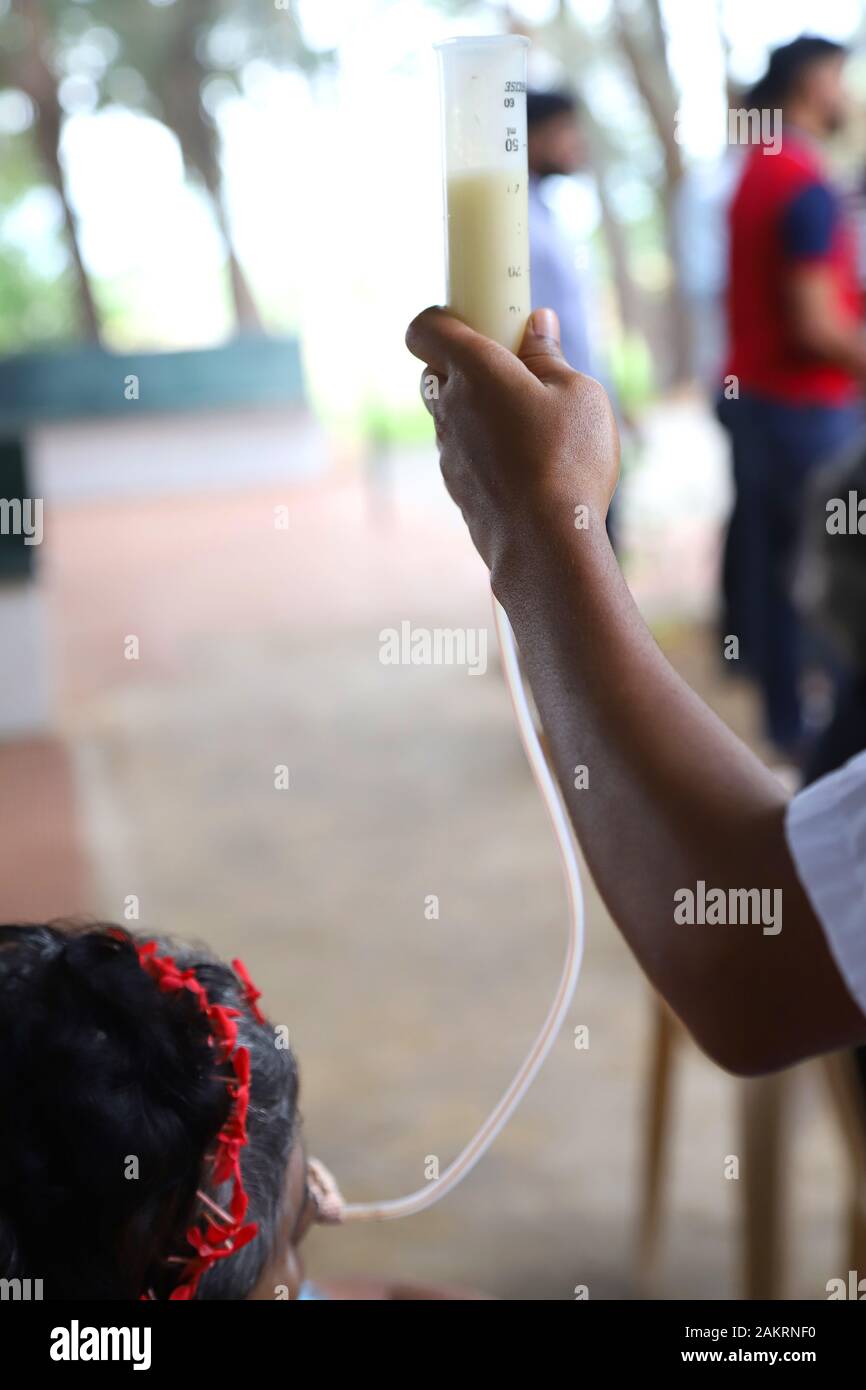 Halten Sie die linke Hand an einem nasogastischen Intubationsschlauch, das den Patienten, die keine Lebensmittel im Mund essen können, flüssig zuführen kann. Stockfoto