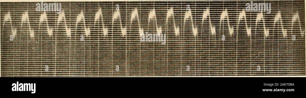 Klinischen Elektrokardiographie., submergethe Sinusfrequenz und flattern. Dass eine solche Funktionale pathologyexists ist jedoch offensichtlich. Wir haben keine Hinweise, dass fluttercan rein von neurogenen Ursprungs sein. Der elektrokardiogramme von Flattern werden von theextremely Schnelle congelador Rate geprägt, mehr als 200 pro Minute, und byinversion der Congelador P-Welle. Teilweise Herz-Block ist auriculoventricular usuallypresent, das Verhältnis von 2:1 bis 5:1; gelegentlich Paroxysmus vom 1:1-Verbindung auftritt, und wieder, komplette Herz - Block vorhanden sein können. Abbildung 51 zeigt den Mechanismus in der Grippe Stockfoto