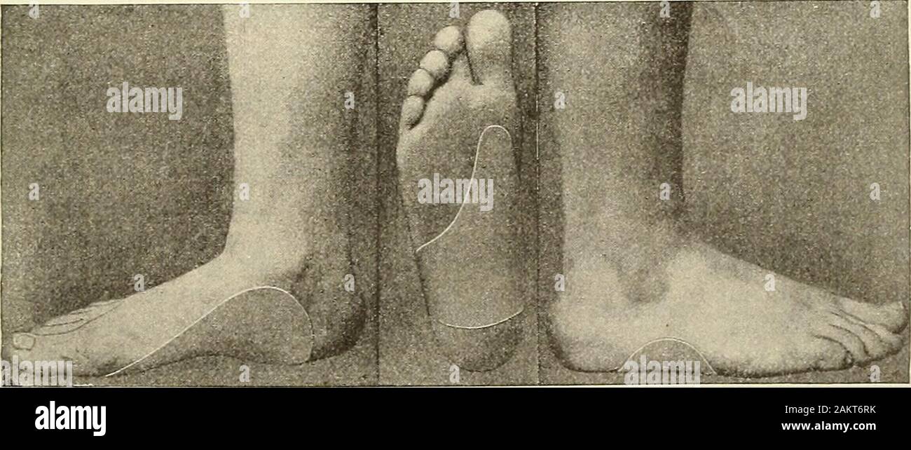 Die moderne Chirurgie, allgemeine und operativen. Abb. 477.-H. August Wilsons Flachbild-Fuß Korrekturschraube. Vorbehaltlich für die Behandlung. Für Bequemlichkeit, Flachbild-Fuß ist in starre andflexible unterteilt. Entweder kann von Schmerz sein. Der Schmerz der Flachbild-Fuß ist usuallythe übermäßige verwenden. Es muss von Alberts Krankheit (Achillodynie), Metatarsalgien differenziert, osteophyten auf dem unter der Oberfläche des Os calcis und Raynauds Krankheit sein. Starre Flachbild-Fuß kann flexibel durch manipu- lative Maßnahmen (nach Whitmans Methode) oder durch die employmentof H. Augustus Wilsons Flachbild-Fuß-Korrektur die Schraube (Abb. 477). T Stockfoto