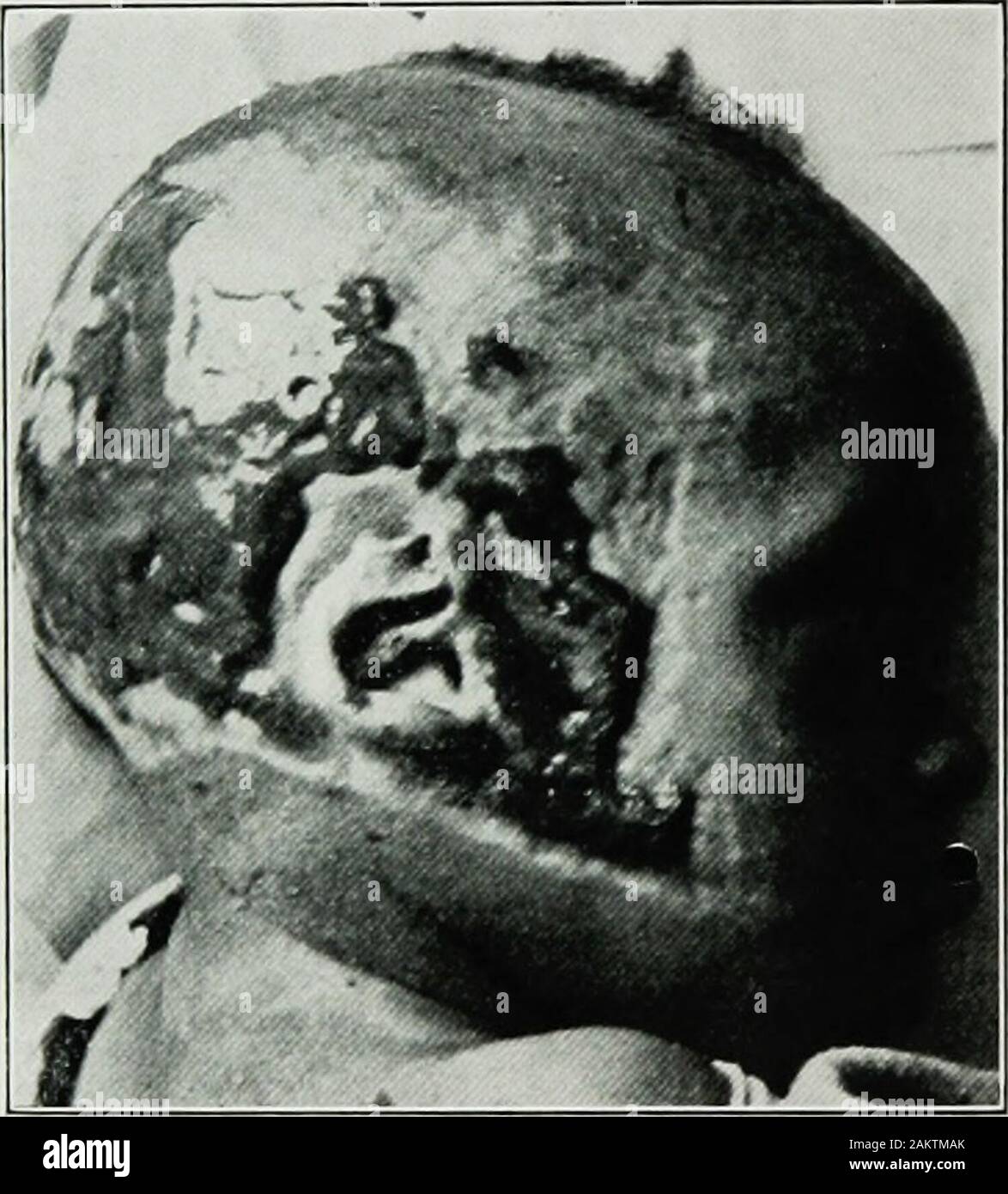 Krieg Chirurgie des faceA Abhandlung über plastische Wiederherstellung nach Verletzungen des Gesichts von John BRoberts.. auf Anregung der Motive auf Kunststoff- und Oralchirurgie mit dem Büro der Chirurg generalIllustrated mit 256 Figuren verbunden vorbereitet. n re-Netz betreiben, wenn die slough ist nach dem Auftreten ofpyogenic Infektion getrennt; und die daraus resultierende Vernarbung Ursachen, durch Kontraktion von fibrösem Gewebe, großen Hubraum und dis-tortion. Diese Deformitäten verändern die oberflächlichen und tiefen Beziehungen von Haut, Muskeln, Gelenke und Knochen. Wenn die kalorische Dermatitis hat sich durch heiße Flüssigkeiten eingerichtet wurde, i Stockfoto