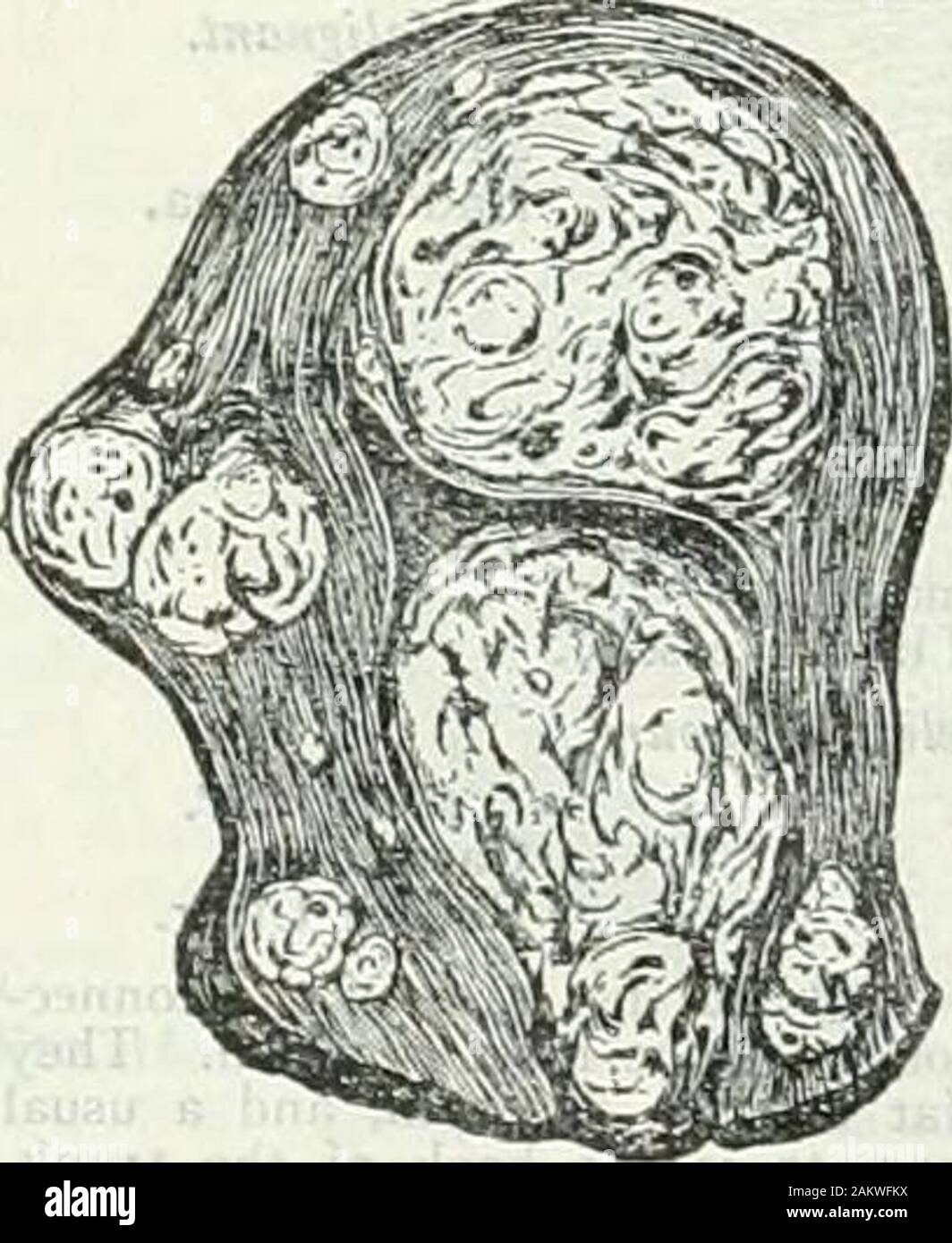 Die Encyclopedia Britannica; ein Wörterbuch der Künste, Wissenschaften, Literatur und allgemeinen Informationen. Sicherung Lipom des Halses Fibrom, (Abb. 7). - Der Tumoren mit fibrösem Gewebe, durch farthe wichtigsten Arc die Myome der Gebärmutter. Eine bessere namefor diese Tumoren beFibromyomata würden, da sie eine unterschiedliche proportionof Muskelfasern alwayscontain. Sie Bankkontokorrent-guthaben nate in der Wand der Gebärmutter, sondern in der Regel kommen intern in der Gebärmutter zu thecavity projecteither oder ex-ternally in die peritonealcavity; und häufig ihre soleconnection mit der uterinewall ist ein Bedienhebel oder pedicleformed aus der Ca Stockfoto