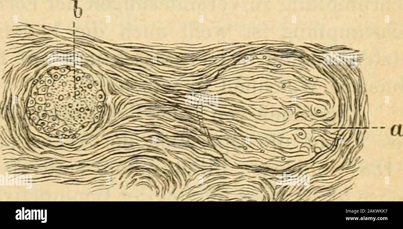 Handbuch der gesammten Augenheilkunde. Fie. 17.. Excitlirtes Stück des Tarsus desoberen Lides bei Trachom. Senk-rechter Schnitt, ein Anhäufungen vonZellplatten. 0 Neugebildete Gefässe.? Hnd.thelscheide varicOs ausgebuch - tet an den Stellen, eine grössereMenge von Kernen sich findet. Häma-toxylinfärbung. lanadabalsampräparat. Hartnack VII. Ocnlar 3. Tarsus des oberen Lides bei Trachom. SenkrechterSchnitt, eine Auslöschung einer Seitenkammer einerMeibomsehen Drüse durch wucherndes Bindegewebe. b Seitenkammer einer gleichen Drüse von derbemBindegewebe umgeben. Carminfärbung. Glycerin-Präparat. Har Stockfoto