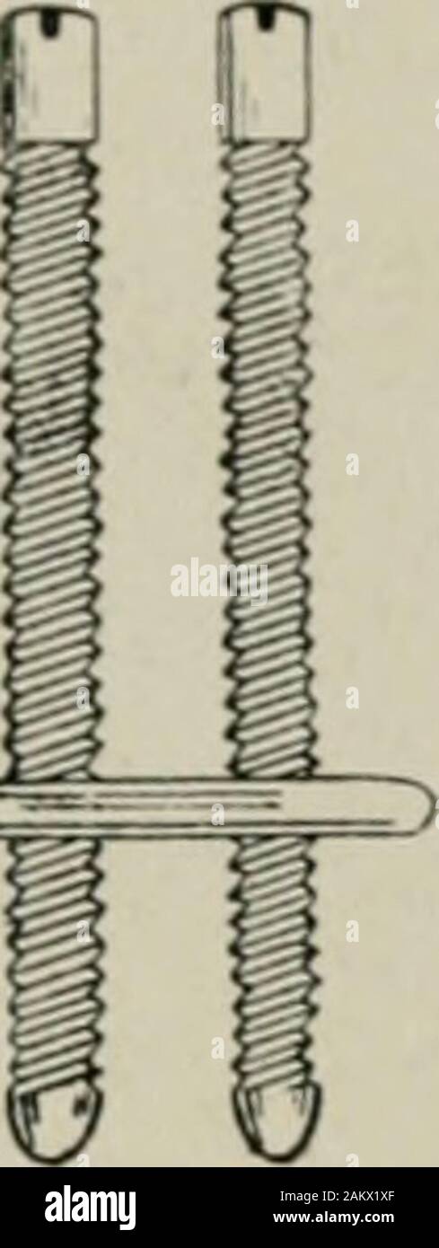 Amerikanische Praxis der Chirurgie: ein vollständiges System der Wissenschaft und die kunst der Chirurgie. Abb. 114.- Weiß Platte zur Befestigung ofUnunited Fraktur nach Resektion. Bruch. Nachdem beide Enden der Knochen aus dem umliegenden Gewebe, aus theyweresawed quer in sound Knochen befreit worden, so dass Sie kamen zusammen Akku. Vier Bohrungen wurden dann in den Knochen mit einer Ahle etwas kleiner als die Schrauben, mit der Platte Öffnungen zu entsprechen gelangweilt. Vier Schrauben, Muttern und Gewinde ausgestattet, die in der Platte, theninserted waren so, dass Sie statt der Platte andfragments fest zusammen (siehe Abbn. 114a Stockfoto