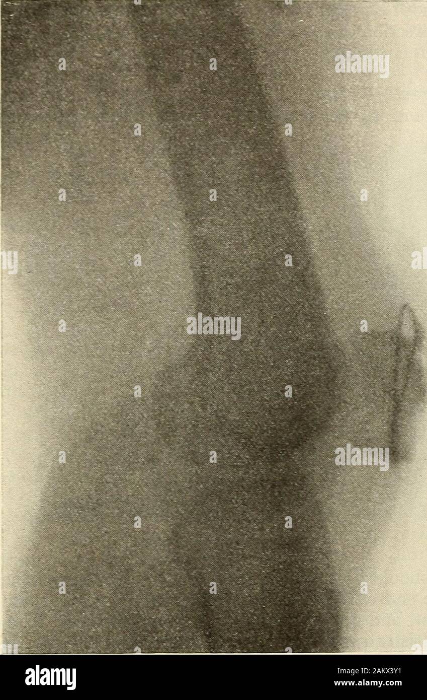 Die moderne Chirurgie, allgemeine und operative. ht ratsam halten wir es am besten, einen offenen Betrieb zu tun, MAK-Ing eine taschenklappen oder eine zentrale Längs einschneiden, sodass die Gemeinsame vom Blut-1 Brit. Med. Jotir., 11. April 1896. Die Behandlung von Frakturen der Patella 607 Punkte durch die Bewässerung mit warmen Salzlösung, Entfernen aller Gewebe von Zwischen thefragments, bohren die Fragmente, vorbei an Silberdraht, t-oisting der Draht anddra^ing die Fragmente zusammen, und Schließen der Wunde (Abb. 373). Insteadof Draht, Seide verwendet werden. In den Fällen, in denen es keine Ver - Starke tendencyto Trennung der Fra Stockfoto
