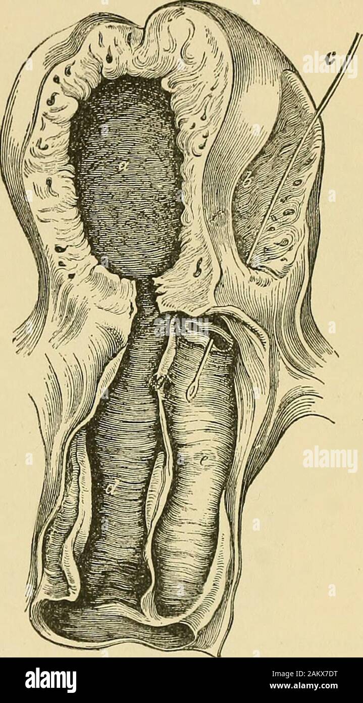 Cyclopaedia von Gynäkologie und Geburtshilfe. e-Fach von der anterioren und posterioren Wand erwähnt hat etwas mit ihm zu tun, aber wir mehr darüber sagen hys Wenn wir consideruterus didelj). Die physiologischen Prozesse sind die gleichen wie im Uterus bicornis. Onecase existiert, gemeldet von W.B.D. Blackwood, in denen abwechselnd von der einen und dem anderen Pol: Der Patient, 22 Jahre alt, klagte über Schmerzen in der lefthypochondrium, Avhich wurde sehr an jedem anderen Zeitraum schwere menstruationoccurred. Ex - 232 ENTWICKLUNGSANOMALIEN der Gebärmutter. aminierung zeigte ein jungfernhäutchen mit zwei Öffnungen, Stockfoto