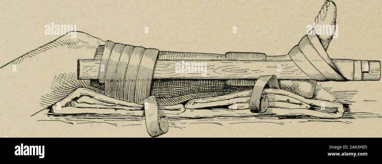Amerikanische Praxis der Chirurgie: ein vollständiges System der Wissenschaft und die kunst der Chirurgie. - Fällt nach Außen, den Oberarm ligament isput auf der Strecke; es ist selten zerrissen, aber in der Regel Tränen aus den internen malleolus, und in der Regel in der Nähe der Basis: außergewöhnlich das Ligament ist aus bei ihren Inser eingerissen - tion auf dem astragal. . Das wadenbein bricht an Ihrem schwächsten Punkt über dem. Abb. 90.- Dupuytrens Geräte für den Einsatz in der Behandlung von Frakturen des Beines. Tibio-fibular Bänder, nämlich zwei zu zwei und ein viertel Zoll von thetip. Das, sagt er, ist typisch Potts Bruch. Symptome. - Diese oft variieren erheblich, ow Stockfoto