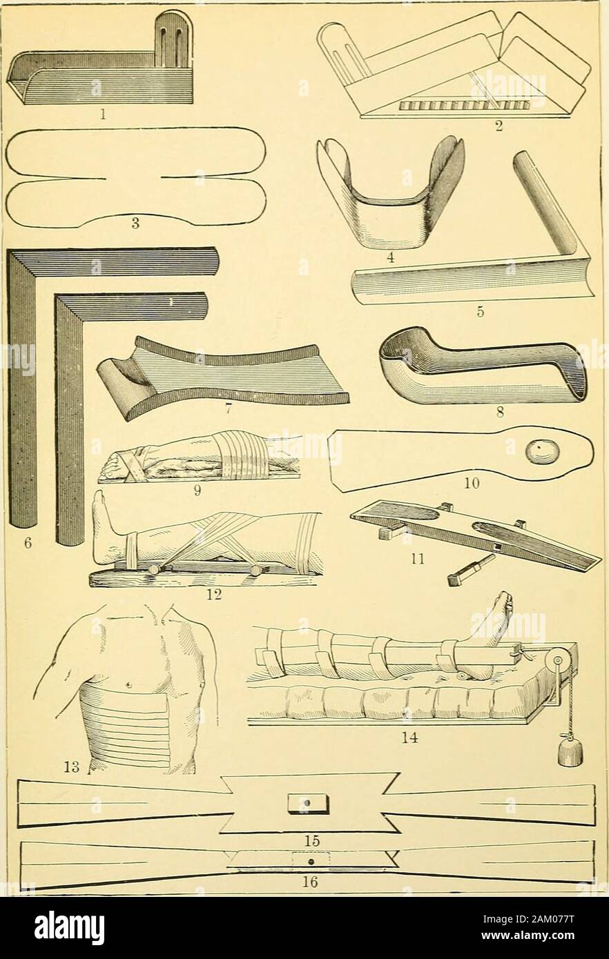 Die moderne Chirurgie, allgemeine und operativen.al, und {d) Trennung der oberen ep-iphysis. Frakturen der anatomischen Hals des Humerus. - Die anatomische neckis den verengten Umfang des Gelenkknorpels Oberfläche, und Frakturen, obwohl selten, Auftreten, vor allem in den Jahren. Die Linie der fractine in manchmal folgt die Eingliederung der Kapsel, in anderen liegt es allein in thecapsule, aber in den meisten ist es ohne die Kapsel über und im capsulebelow; daher der Begriff Intrakapsulären ist selten korrekt als Bezeichnung. Ein solcher Bruch kann beeinträchtigt werden. Die Ursache ist direkte Gewalt oder Stockfoto