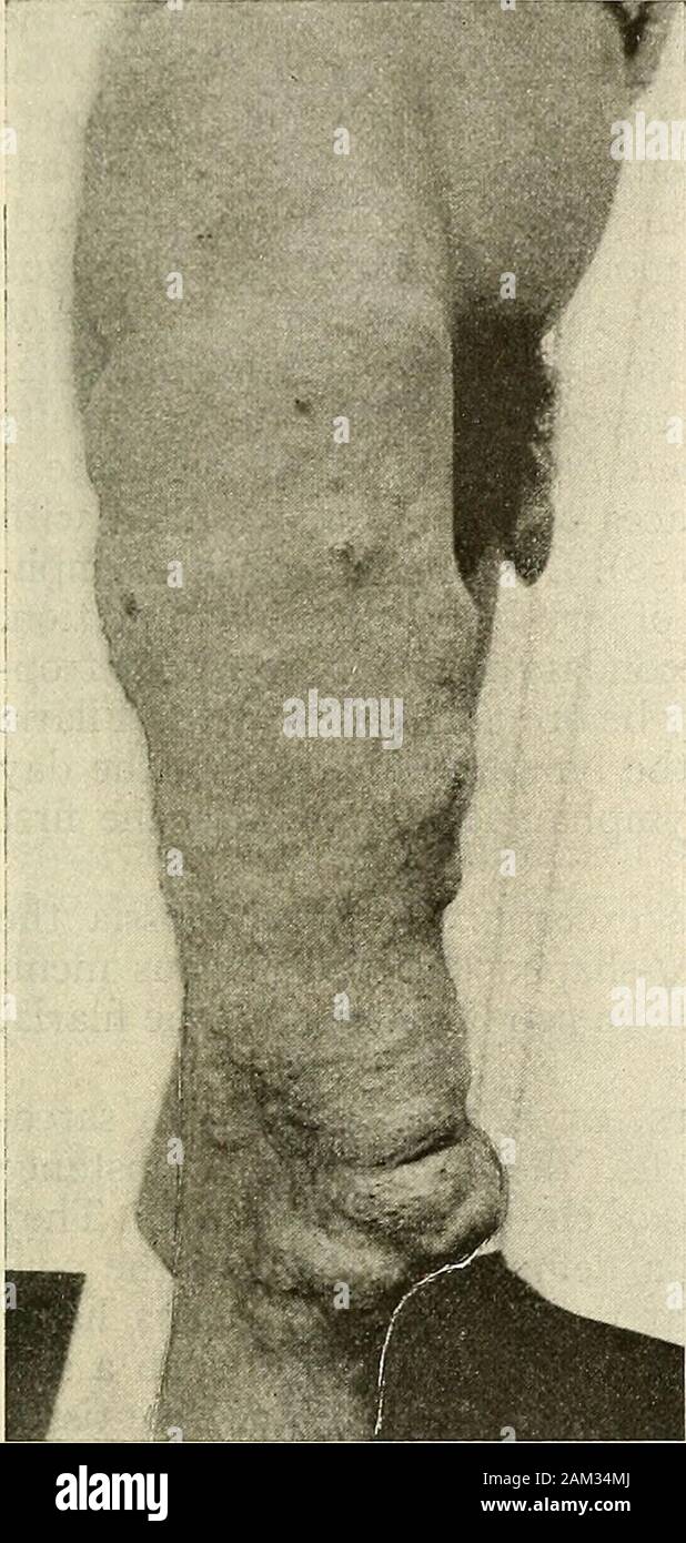 Die moderne Chirurgie, allgemeine und operative. oder becompletely Exzidiert. Exzision ist in der Regel der beste Plan für die Heilung des angiomata. Es ist schnell, gründlich und hinterlässt aber eine triviale Narbe. Exzision sollte immer beemployed Wenn wir sind uns sicher, dass die Ränder der Wunde subsequentlyapproximated sein kann und dass es nicht zu einer gefährlichen Verlust von Blut. Ist es manchmal gerechtfertigt eine angioma verbrauchsteuerpflichtige Waren, auch wenn die Angleichung der woundwill offensichtlich unmöglich sein. In einem solchen Fall die rohen Oberfläche sollte coveredwith Thiersch Transplantate werden. Die meisten oberflächlichen Naevi und einige höhlenartige angiomata behandelt werden können b Stockfoto