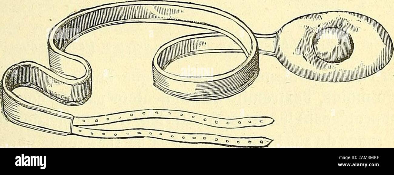 Chirurgie Journaliere Des Hopitaux De Paris Repertoire De Therapeutique Chirurgicale Abb 358 Pelote De Caoutchoucremplie Dair Giessen Hernie Om Bilicale Enfant Abb 359 Die Bandage Pour Ta Hernie Ombilicale Adulte Sion