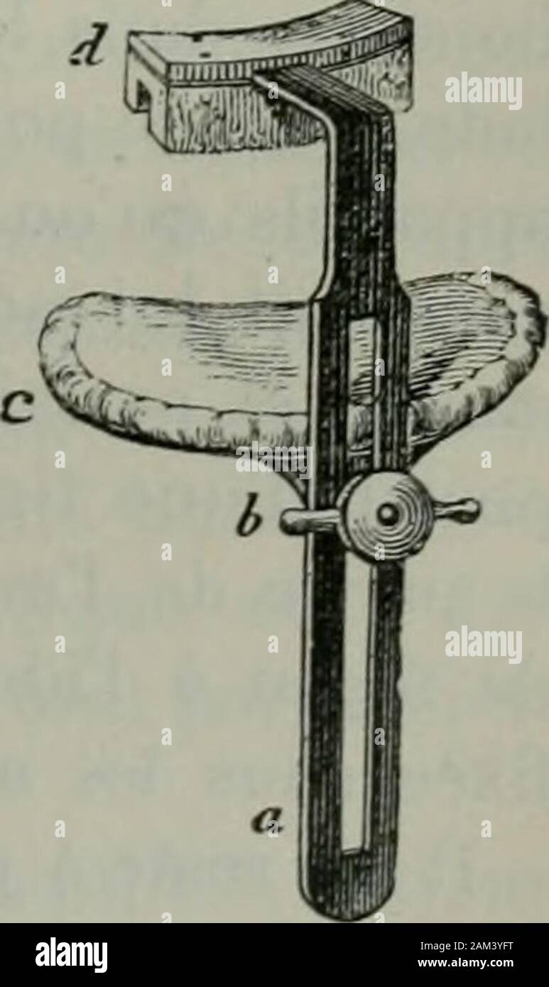 "Traité de Chirurgie. urpoint dappui à la fois sur les doits et sur le Menton, Ueb - çant ainsi une Double pression et maintenant limmobilitédes Fragmente entre Ces deux points dappui. Dès 1780, Ghopart et Desault avaient imaginé cette Méthode. Depuiscette époque Ruthenick, Kluge, Bush, Malgaigne, Jousset, Houzelot, Morel-Lavallée, Kingsley, Martin, etc., Ont suivila même Voie. Un des plus connus de ces appareils est Celui de Hou - zelot, qui Remonte à 1826. Il se Compose de deux Plaketten ^.,," • 1 1 1^^^-* • - Appareil métalliques réunies par une tige Verticale; la Plaque Bol-de Houzelot. rie Stockfoto