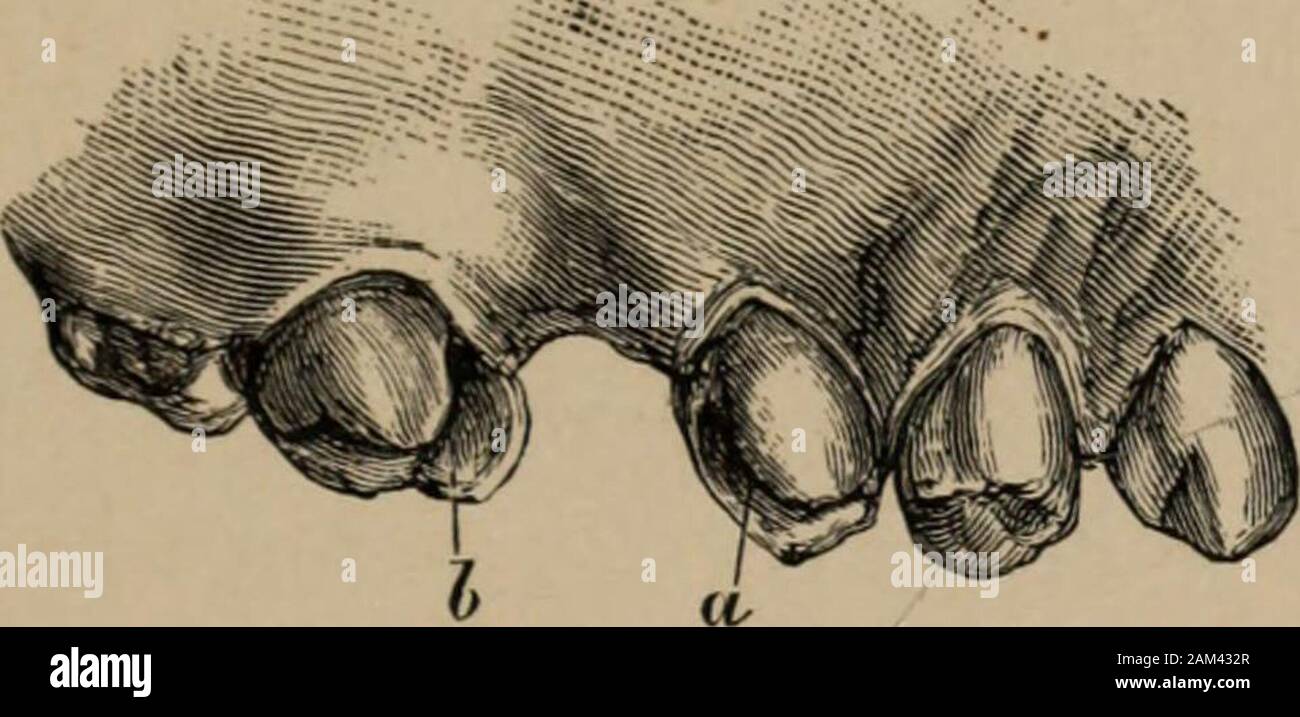 Vorträge über operative zahnärztliche Chirurgie und Therapeutika. die Abb. 64. 58. eine Uhr. Hohlräume in Molar und Bicuspid Zähne, - Bukkal. Hier Man wird bemerken, dass der Bogen abgeschlossen ist, mit Ausnahme der Ersten superior linken Molaren; und wie in der Regel auftritt, es sei denn, der Zähne bei 151 sehr früh extrahiert werden, oder vor dem Ausbruch der dentes - sapientise, teilweise Schließung nur Der tlie Zwischenraum ist theresult.. Abb. 59. a b. Gleiche Hohlräume vorbereitet, mehrsprachiges anzeigen. In diesem Fall, es wird gesehen werden, dass die beiden bicuspidshave zurück, um den Vormarsch der Molaren, die zweite bicuspi zu antizipieren Stockfoto