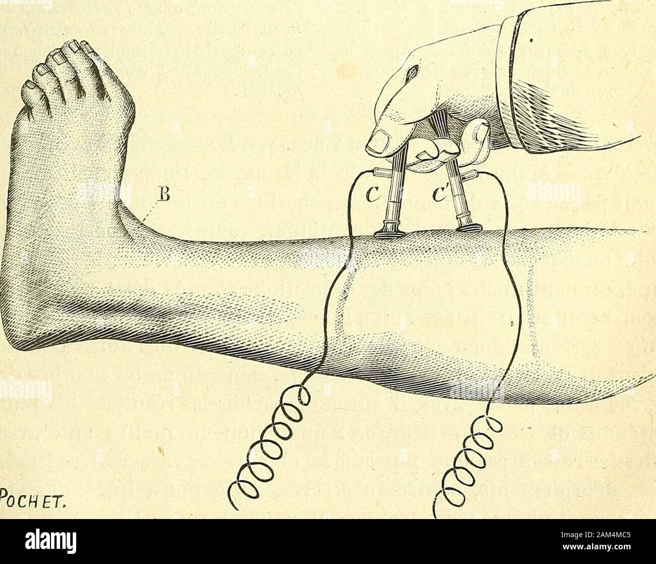 Chirurgie journalière des Hopitaux de Paris: Répertoire de thérapeutique chirurgicale. ? 0 CHET. °0 CT EIN BILD. 252. - Mouvement du Pied vu par sa Gesicht Internierten, sous linfluence de lafaradisation eine maximale du jambier antérieur. (Duchenne de Boulogne).. Toc h ET. Abb. 253. - Mouvement du Pied vu par sa Gesicht externe, sous linfluence de lafaradisation du jambier antérieur. (Duchenne de Boulogne). 340 HOPITAL Saint- Louis. LE DOCTEUR DUPLAY. Pendant que le Pied est resté dans cette Haltung vicieuse, auf lesrompt brusquement en pesant sur le Mitglied en Sens contraire duvalgus: La déviation se trouve Ein Stockfoto