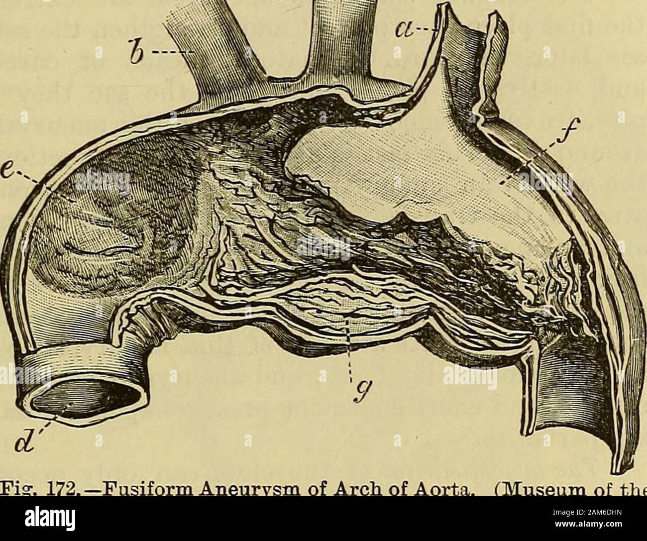 Ein System der Chirurgie. In Ermangelung einer solchen clotsin fusiform aneurysms gefunden wird. Ein weiterer wahrscheinlicher Aussicht ist thatcoagulation tritt nur in ruhigen Wirbel und backwatersof ein Aneurysma, und dass in allen Fällen, wenn das Gerinnsel gebildet trueblood IST-Klumpen - fibrin und Blutkörperchen - und dass es sich in der Natur und das Erscheinungsbild von greatlyaltered des Drucks, zu dem Es isexposed. Der Druck drückt sich das Gerinnsel gegen den Sac, andsqueezes aus dem Serum, das rote Blutkörperchen, dann zerfallen, und so einen weißen fibrinöse Clot erreicht wird, und wenn mehrere Blutgerinnsel haben beenformed und damit gedrückt Stockfoto