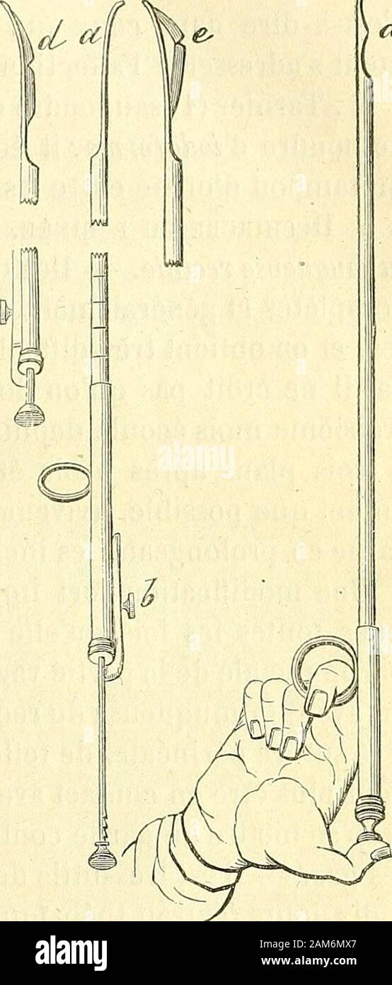 Chirurgie journalière des Hopitaux de Paris: Répertoire de thérapeutique. chirurgicale en avant, prendune Richtung très-oblique éminem- günstigen à-la". Lo-pération terminée, il suffit de Pres-ser sur un bouton Insassen le Mi-lieu du Ressort b pour que la tige seretire en arrière De cachant lalame dans la gaîne. Traitement général. - Il croit, de plus, que le traitement hygiéni-que a une certaine Einfluss sur la durée du Temps que met lurè-thre à revenir à un-Kaliber Raisonnable. - Éviter les Nahrungsmittel tropsucculents et Trop abondants. - Éviter les Boissons en excès et sur-l tout Stockfoto